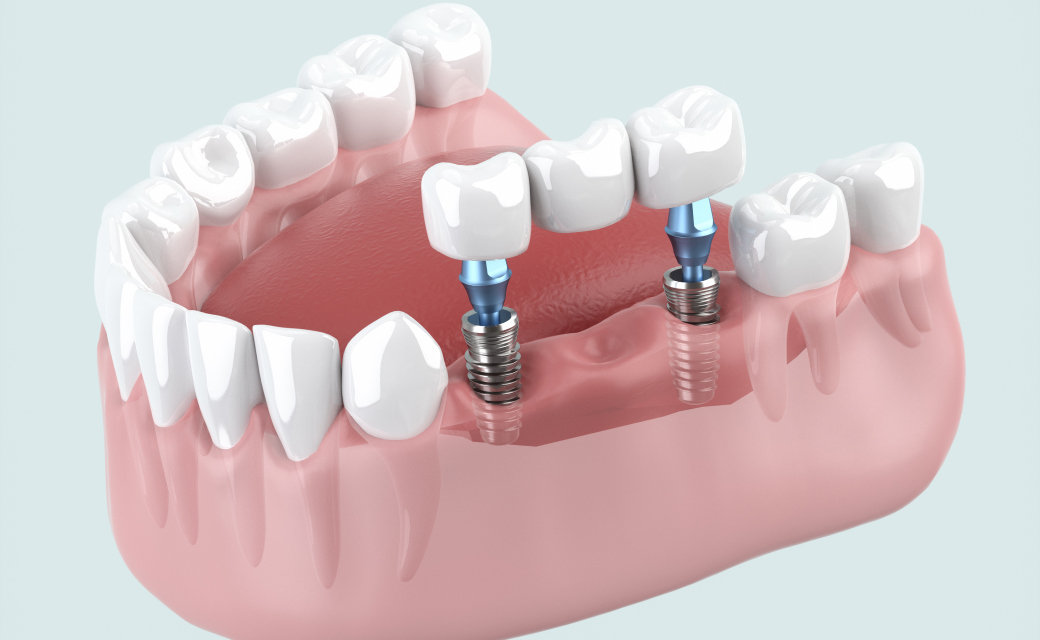 ストローマンインプラント