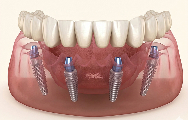 抜歯から仮歯まで