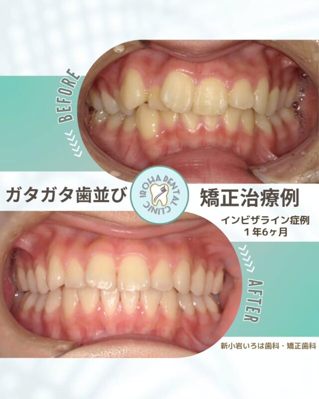 こんにちは。新小岩いろは歯科です🍀

👉今回は、マウスピース矯正によるガタガタ歯列の治療例をご紹介しました。

鏡を見るたびに気になる「ガタガタ」な歯並び。「この歯並び、本当にきれいになるのかな？」「矯正って大変そう…」そんな不安を抱えていませんか？

ご安心ください。ガタガタの歯並びは、歯科矯正で大きく改善できる可能性を秘めています。

諦めていた笑顔、取り戻しませんか？🦷

矯正は見た目のコンプレックスだけでなく、実は様々な健康リスクも抱えています💡

🍀ガタガタの歯並びを直すメリット

✅見た目が整い、自信につながります

✅歯磨きがしやすくなり、虫歯・歯周病予防に

✅噛み合わせが改善され、顎や肩の不調が減ることも

⏳ いつ始めるのがベスト？
早めの相談が◎。重度になる前にスタートすれば、
マウスピース矯正など負担の少ない治療も選べます 。

💡あなたに合った矯正治療の選択肢

「どんな矯正方法があるの？」と気になる方もいるでしょう。当院では、患者様一人ひとりのライフスタイルやご希望に合わせた治療法をご提案できます。

表側矯正: 歯の表面に装置をつける一般的な方法。
裏側矯正: 装置が外から見えにくい、目立たない方法。
マウスピース型矯正: 取り外し可能で、日常生活への影響が少ない透明なマウスピースを使った方法。

✨まずはご相談ください

「でこぼこの歯、どこまで治せるんだろう？」という疑問や不安は、実績のある矯正歯科にご相談いただくのが一番の近道です💫

当院では、あなたの歯並びの状態を詳しく拝見し、どのような変化が期待できるのか、最適な治療法は何かを丁寧にご説明いたします。

悩みを抱え込まずに、ぜひ一度、お気軽にご相談ください。
あなたの未来の笑顔を、一緒にデザインしましょう🌈

矯正治療を受けるにあたり、ご不安に思っていることや疑問点などございましたら、お気軽にご相談ください🍀

無料相談はプロフィールリンクから💡🌸

@shinkoiwairoha.dc
┈ ┈ ┈┈ ┈ ┈ ┈ ┈┈ ┈ ┈┈ ┈ ┈ ┈ ┈
新小岩いろは歯科・矯正歯科🦷✨
📞03-6231-5751

【公式HP】
https://shinkoiwa-iroha-dc.jp/

@shinkoiwairoha.dc

📍JR新小岩駅徒歩2分　第28東ビル3F
⌚診療時間 ｜ 月〜土 9:00〜17:00
休診日：日曜・祝日
┈ ┈ ┈ ┈ ┈ ┈ ┈ ┈┈ ┈ ┈ ┈ ┈
#新小岩#矯正#小児歯科#小児矯正#歯科口腔外科#新小岩いろは歯科#歯列矯正期間#矯正したい#小児歯科矯正#こども歯ならび#こども矯正#矯正歯科#歯並び#歯ならび#拡大床#マウスピース矯正#大人の歯列矯正#噛み合わせ#矯正カウンセリング#歯科矯正費用#矯正相談#矯正相談無料