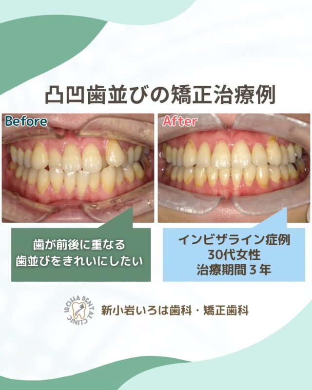 こんにちは。新小岩いろは歯科です🍀

👉今回は、マウスピース矯正によるデコボコ歯列の治療例をご紹介しました。

「もう遅い」は思い込み？ 30代からの矯正という選択

30代といえば、仕事で責任ある立場を任されるようになり、少しずつ経済的な余裕も出てくる年代です。結婚や出産、子育てなど、ライフステージの変化が重なり、多忙な日々を過ごしている方も多いことでしょう。

そんな中でふと気になるのが、自分自身の“身なり”や“見た目”。
「昔より口元に年齢が出るようになったかも…」
「前歯の歪み、気になっていたけど、今さら？」
と、歯並びに目が向き始める方も多いはずです。

「矯正は子どもの頃にするもの」
そんなイメージが根強くありますが、実際は30代から矯正を始める人が増えているのが現実です。

年齢を重ねることで、歯や歯ぐきの状態によっては矯正治療が難しくなるケースもあります。

たとえば歯周病などが進行していると、治療の選択肢が限られてしまうことも。
そのため、「気になっているけれど踏み出せない」という方こそ、今がタイミングなのかもしれません💡

また、大人になってからの矯正には多くのメリットがあります。
自分で矯正の目的をしっかり理解し、モチベーション高く治療に取り組めるのは、大人ならではの強みです。目立ちにくい矯正装置（マウスピース型など）も増えており、仕事や育児と両立しながら続けることも十分可能です🦷✨

何より、口もとのコンプレックスから解放され、思いっきり笑える日常が待っているかもしれません。

矯正治療の期間は、症状や方法によって6カ月〜3年とさまざまです。
「この先の人生を、今よりもっと自信をもって過ごしたい」と感じているなら、30代はまだまだ“間に合う”年齢です。

まずは、気軽な相談から始めてみませんか？

当院では、あなたの歯並びの状態を詳しく拝見し、どのような変化が期待できるのか、最適な治療法は何かを丁寧にご説明いたします。

悩みを抱え込まずに、ぜひ一度、お気軽にご相談ください。
あなたの未来の笑顔を、一緒にデザインしましょう🌈

矯正治療を受けるにあたり、ご不安に思っていることや疑問点などございましたら、お気軽にご相談ください🍀

無料相談はプロフィールリンクから💡🌸

@shinkoiwairoha.dc
┈ ┈ ┈┈ ┈ ┈ ┈ ┈┈ ┈ ┈┈ ┈ ┈ ┈ ┈
新小岩いろは歯科・矯正歯科🦷✨
📞03-6231-5751

【公式HP】
https://shinkoiwa-iroha-dc.jp/

@shinkoiwairoha.dc

📍JR新小岩駅徒歩2分　第28東ビル3F
⌚診療時間 ｜ 月〜土 9:00〜17:00
休診日：日曜・祝日
┈ ┈ ┈ ┈ ┈ ┈ ┈ ┈┈ ┈ ┈ ┈ ┈
#新小岩いろは歯科#新小岩#矯正#小児歯科#小児矯正#歯科口腔外科#歯列矯正期間#矯正したい#小児歯科矯正#こども歯ならび#こども矯正#矯正歯科#歯並び#歯ならび#拡大床#マウスピース矯正#大人の歯列矯正#噛み合わせ#矯正カウンセリング#歯科矯正費用#矯正相談#矯正相談無料