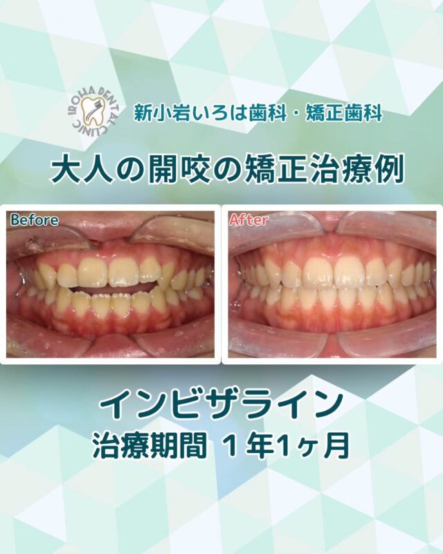 こんにちは。新小岩いろは歯科です🍀

👉今回は、マウスピース矯正による開校（オープンバイト）の矯正治療例をご紹介しました。

治療を終えた患者様から「最初は半信半疑でしたが、少しずつ歯並びが整い、しっかり噛めるようになった時の感動は忘れられません。見た目も機能も大きく変わり、人前に出るのも前向きになれました。」と、うれしいお言葉をいただきました🦷✨

「なんとなく歯並びは悪くないのに、食事がしにくい」
「麺類がうまく噛み切れず、気づけば食べこぼしている」
こんなお悩みを抱えていませんか？

その症状、実は“開咬（オープンバイト）”かもしれません。

開咬とは、上下の前歯に大きな隙間ができてしまい、前歯でしっかり噛み合わない噛み合わせのズレのことです。
「オープン（開いている）バイト（咬み合わせ）」という意味から、そう呼ばれています。

ぱっと見た目には歯並びがきれいに見えることもあり、気づかないまま過ごしてしまう方も多くいらっしゃいます。

🟢開咬を放置する6つのリスク

1. 心理的ストレス

歯並びや口元の形にコンプレックスを感じ、自然な笑顔や会話に自信が持てなくなることがあります。
唇がしっかり閉じられない場合、顔の印象にまで影響が出ることも。

2. 虫歯や歯周病のリスク増加

噛み合わせのバランスが悪いため、一部の歯に負担がかかり、汚れもたまりやすくなります。
その結果、むし歯や歯周病を引き起こしやすくなってしまうのです。

3. 歯の摩耗・亀裂

噛む力の偏りから、一部の歯に過度な負担がかかることで、歯がすり減ったり、ひび割れが生じたりします。

4. 消化不良

前歯でうまく噛み切れないため、食べ物をしっかり噛まずに飲み込んでしまいがち。
その結果、胃腸に負担がかかり、消化不良を引き起こすこともあります。

5. 顎関節症のリスク

噛み合わせのズレが長期化することで、顎の関節に異常が起こり、痛みや開口障害などの症状が現れる可能性があります。

6. 発音が不明瞭になる

特に「サ行」「タ行」など、舌先を使う音が出しにくくなる場合があります。
接客や電話対応など、人と話す機会が多い方にとっては大きなストレスに。

🟢矯正治療で「自然な笑顔」と「本来の噛む力」を取り戻す

「矯正は見た目のための治療」だと思われがちですが、開咬のような噛み合わせの問題は、身体や心に大きな影響を及ぼす可能性があります。

だからこそ、今ある不便や不安をそのままにせず、矯正治療という選択を前向きに検討してみてほしいのです💡

治療には段階的なステップとご負担が伴いますが、「食事のしやすさ」「会話のしやすさ」「自信ある笑顔」など、得られる変化は人生の質を確実に高めてくれます。実際に当院で治療を受けられた多くの方が、その変化を実感され、日々の暮らしに前向きな変化があったとお声を寄せてくださっています。

当院では、患者さん一人ひとりの歯並びやライフスタイルに合わせた治療計画をご提案し、疑問や不安に丁寧に耳を傾け、一つひとつ解消していきます。歯並びは本当に人それぞれなので、インビザラインが気になっている方は、ぜひ一度お気軽にご相談ください💫

矯正治療を受けるにあたり、ご不安に思っていることや疑問点などございましたら、お気軽にご相談ください🍀

無料相談はプロフィールリンクから💡🌸

@shinkoiwairoha.dc
┈ ┈ ┈┈ ┈ ┈ ┈ ┈┈ ┈ ┈┈ ┈ ┈ ┈ ┈
新小岩いろは歯科・矯正歯科🦷✨
📞03-6231-5751

【公式HP】
https://shinkoiwa-iroha-dc.jp/

@shinkoiwairoha.dc

📍JR新小岩駅徒歩2分　第28東ビル3F
⌚診療時間 ｜ 月〜土 9:00〜17:00
休診日：日曜・祝日
┈ ┈ ┈ ┈ ┈ ┈ ┈ ┈┈ ┈ ┈ ┈ ┈
#新小岩#矯正#小児歯科#小児矯正#歯科口腔外科#新小岩いろは歯科#歯列矯正期間#矯正したい#小児歯科矯正#こども歯ならび#こども矯正#矯正歯科#歯並び#歯ならび#拡大床#マウスピース矯正#大人の歯列矯正#噛み合わせ#矯正カウンセリング#矯正相談#矯正相談無料