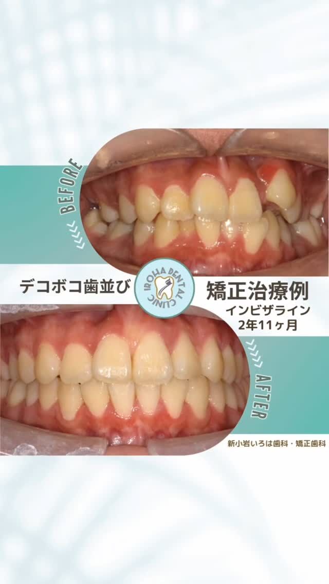 こんにちは。新小岩いろは歯科です🍀

👉今回は、マウスピース矯正による八重歯とデコボコ歯列の治療例をご紹介しました。

八重歯や歯並びでお悩みの方へ――

「あれ？なんだか印象が変わった？」と言われるその日まで

「歯科矯正をすると、笑顔が増える」
「八重歯の矯正は、特に顔の印象が変わりやすい」

――そんな話を聞いたことはありませんか？

🔹 八重歯がもたらす「目立つ」悩み

特に八重歯（やえば）は、歯の中でもとても目立つ存在です。
上の前歯から3本目にある“犬歯”が、ほかの歯のスペースに入りきれず、外に飛び出してしまった状態。チャームポイントとして親しまれることもありますが、

✅歯みがきがしづらい
✅虫歯や歯周病のリスクが高い
✅笑顔や横顔に自信が持てない

など、実は見た目だけでなく健康面にも影響を与えています。

だからこそ、矯正治療によってこの八重歯を整えると、
「顔の印象が変わった」と感じる方が多いのです。

🔹 矯正治療は、どこで受けても同じ？

歯科矯正には専門的な知識と技術が必要です。
特に八重歯のように歯の生え方に大きなズレがある場合は、
「ただ並べる」のではなく、噛み合わせや顔のバランスを考えた“設計力”が必要です。

👉だからこそ、矯正治療は「どこでやっても同じ」ではありません。
満足のいく結果を目指すなら、矯正治療に力を入れている歯科医院を選ぶことが大切です。

「もっと早く始めればよかった」そう思える未来のために
歯並びの悩みは、年齢や性別に関係なく誰にでも起こるもの。
でも、「気になるけど、今さら…」と先送りにしてしまう方がとても多いのです。

けれど、悩みは放っておいても消えてくれません。
むしろ、放置することで歯ぐきの状態が悪化したり、噛み合わせが崩れていくこともあります。

💡私たちは、矯正に対する不安や疑問にしっかり向き合いながら、あなたのペースに合わせて治療を進めていきます。

「いつか治したい」と思っていたあの日の自分に、
「やってよかった」と言える未来を💫

当院では、一人ひとりの歯並びの状態を詳しく拝見し、どのような変化が期待できるのか、最適な治療法は何かを丁寧にご説明いたします。

悩みを抱え込まずに、ぜひ一度、お気軽にご相談ください。
あなたの未来の笑顔を、一緒にデザインしましょう🌈

矯正治療を受けるにあたり、ご不安に思っていることや疑問点などございましたら、お気軽にご相談ください🍀

無料相談はプロフィールリンクから💡🌸

@shinkoiwairoha.dc
┈ ┈ ┈┈ ┈ ┈ ┈ ┈┈ ┈ ┈┈ ┈ ┈ ┈ ┈
新小岩いろは歯科・矯正歯科🦷✨
📞03-6231-5751

【公式HP】
https://shinkoiwa-iroha-dc.jp/

@shinkoiwairoha.dc

📍JR新小岩駅徒歩2分　第28東ビル3F
⌚診療時間 ｜ 月〜土 9:00〜17:00
休診日：日曜・祝日
┈ ┈ ┈ ┈ ┈ ┈ ┈ ┈┈ ┈ ┈ ┈ ┈
#新小岩いろは歯科#新小岩#矯正#小児歯科#小児矯正#歯科口腔外科#歯列矯正期間#矯正したい#小児歯科矯正#こども歯ならび#こども矯正#矯正歯科#歯並び#歯ならび#拡大床#マウスピース矯正#大人の歯列矯正#噛み合わせ#矯正カウンセリング#歯科矯正費用#矯正相談#矯正相談無料