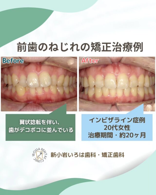 こんにちは。新小岩いろは歯科です🍀

👉今回は、マウスピース矯正での前歯のねじれとデコボコ歯列の治療例をご紹介しました。

話したり笑ったときの口元、ふとした瞬間に目に飛び込んでくるから、どうしても気になりますよね。

もし歯並びに不安を抱えているなら、人前で口を開けるのもためらってしまう…そんな経験、あなたにもありませんか？

特に、前歯がねじれて内側に入り込んでいる「翼状捻転（よくじょうねんてん）」は、歯並びのコンプレックスとして深く悩んでいる方が少なくありません。

この「ねじれ」は、見た目だけでなく、実は将来のお口の健康にも関わってきます。しかし、「矯正って大掛かりになりそう…」と不安に感じるかもしれませんね。

翼状捻転の治療方法は、症状の度合いによって様々です。軽度であれば部分的な矯正装置で済む場合もありますし、中程度や重度の場合は、歯を並べるためのスペース確保が必要になることもあります✨

大切なのは、「早めの受診」です。不安に感じたその時こそ、ぜひ専門の歯科医師に相談してください。症状が軽いうちであれば、治療期間を短く抑えられる可能性も高まります。

あなたの「ねじれ」の原因をしっかり見極め、最適な治療法をご提案します。前歯だけの矯正で解決できるのか、それともお口全体のバランスを整える必要があるのか。専門的な検査を通して、あなたにぴったりの治療計画を一緒に立てていきましょう💫

歯のねじれに悩む日々から卒業し、自信を持って笑顔を見せられる未来を、私たちと一緒に目指しませんか？💡

当院では、あなたの歯並びの状態を詳しく拝見し、どのような変化が期待できるのか、最適な治療法は何かを丁寧にご説明いたします🦷✨

悩みを抱え込まずに、ぜひ一度、お気軽にご相談ください。
あなたの未来の笑顔を、一緒にデザインしましょう🌈

矯正治療を受けるにあたり、ご不安に思っていることや疑問点などございましたら、お気軽にご相談ください🍀

無料相談はプロフィールリンクから💡🌸

@shinkoiwairoha.dc
┈ ┈ ┈┈ ┈ ┈ ┈ ┈┈ ┈ ┈┈ ┈ ┈ ┈ ┈
新小岩いろは歯科・矯正歯科🦷✨
📞03-6231-5751

【公式HP】
https://shinkoiwa-iroha-dc.jp/

@shinkoiwairoha.dc

📍JR新小岩駅徒歩2分　第28東ビル3F
⌚診療時間 ｜ 月〜土 9:00〜17:00
休診日：日曜・祝日
┈ ┈ ┈ ┈ ┈ ┈ ┈ ┈┈ ┈ ┈ ┈ ┈
#新小岩いろは歯科#新小岩#矯正#小児歯科#小児矯正#歯科口腔外科#歯列矯正期間#矯正したい#小児歯科矯正#こども歯ならび#こども矯正#矯正歯科#歯並び#歯ならび#拡大床#マウスピース矯正#大人の歯列矯正#噛み合わせ#矯正カウンセリング#歯科矯正費用#矯正相談#矯正相談無料