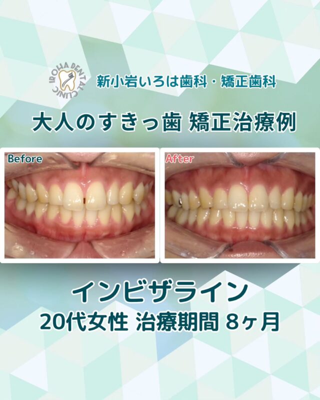 こんにちは。新小岩いろは歯科です🍀

鏡を見るたびに、前歯の隙間が気になる。
人前で笑うとき、つい手で口元を隠してしまう——。
そんな「すきっ歯」に悩む方は、実は少なくありません。

👉見た目だけの問題に思えるかもしれませんが、すきっ歯には見た目以上のデメリットが隠れています。

🟢すきっ歯が与える影響とは？
すきっ歯とは、本来ぴったり並んでいるはずの歯と歯の間に隙間ができている状態。
代表的なタイプには以下の2つがあります

空隙歯列（くうげきしれつ）：全体的に隙間が空いている

正中離開（せいちゅうりかい）：前歯の真ん中だけに隙間がある

こうしたすきっ歯を放置すると、次のような問題につながることもあります。

✅見た目が幼く、頼りなく見られがち

✅滑舌が悪くなる

✅食べ物が詰まりやすく、虫歯や歯周病のリスクが上がる

✅噛み合わせが悪く、顎に負担がかかる

また、大人になってからすきっ歯になることもあり、歯周病や加齢による歯茎の後退、歯を失ったまま放置することが主な原因です。

🟢自力では治せない「すきっ歯」。安全で確実な方法とは？
「指で押せば少し動くかも…」
そんなふうに考えて自己流の“矯正”を試みる方もいますが、それは絶対にNGです。
間違った力を加えると、歯根を傷つけたり、歯を失う原因にもなりかねません。

すきっ歯を根本的に改善したいなら、矯正治療がもっとも確実な方法です🦷✨

🟢歯列矯正で叶うのは、見た目の改善だけじゃない
歯列矯正は、ワイヤーやマウスピースで歯に適切な力をかけ、ゆっくりと理想の位置に動かしていく治療です。

すきっ歯の改善だけでなく、

🔹噛み合わせの調整

🔹歯の清掃性の向上

🔹発音の改善

といった口腔内の総合的な健康にもつながります💡

当院では、目立ちにくい「マウスピース矯正（インビザライン）」や、気になる部分だけを整える「部分矯正」など、患者様のライフスタイルに合った治療法を提案しています。

🟢 不安な方には「矯正無料相談」から
「費用はどれくらいかかるの？」
「自分の歯並びでも治せるの？」

そんな疑問や不安に寄り添うために、当院では矯正無料相談を行っています。

当院では、患者さん一人ひとりの歯並びやライフスタイルに合わせた治療計画をご提案し、疑問や不安に丁寧に耳を傾け、一つひとつ解消していきます。歯並びは本当に人それぞれなので、ぜひ一度お気軽にご相談ください💫

矯正治療を受けるにあたり、ご不安に思っていることや疑問点などございましたら、お気軽にご相談ください🍀

無料相談はプロフィールリンクから💡🌸

@shinkoiwairoha.dc
┈ ┈ ┈┈ ┈ ┈ ┈ ┈┈ ┈ ┈┈ ┈ ┈ ┈ ┈
新小岩いろは歯科・矯正歯科🦷✨
📞03-6231-5751

【公式HP】
https://shinkoiwa-iroha-dc.jp/

@shinkoiwairoha.dc

📍JR新小岩駅徒歩2分　第28東ビル3F
⌚診療時間 ｜ 月〜土 9:00〜17:00
休診日：日曜・祝日
┈ ┈ ┈ ┈ ┈ ┈ ┈ ┈┈ ┈ ┈ ┈ ┈
#新小岩#矯正#小児歯科#小児矯正#歯科口腔外科#新小岩いろは歯科#歯列矯正期間#矯正したい#小児歯科矯正#こども歯ならび#こども矯正#矯正歯科#歯並び#歯ならび#拡大床#マウスピース矯正#大人の歯列矯正#すきっ歯#すきっ歯矯正#すきっ歯治療#噛み合わせ#矯正カウンセリング#矯正相談#矯正相談無料