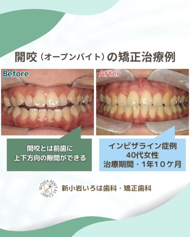 こんにちは。新小岩いろは歯科です🍀

👉今回は、マウスピース矯正による開校（オープンバイト）の矯正治療例をご紹介しました。

「あれ？前歯が噛み合わない…」そのお悩み、もしかして「開咬」かも？

「ラーメンがうまく噛み切れない」「サンドイッチを前歯で食べにくい」「なんだか滑舌（かつぜつ）が悪くなった気がする」

もし、このようなお悩みを感じているなら、それは「開咬（かいこう）」という歯並びかもしれません。

❇️別名「オープンバイト」とも呼ばれるこの状態は、奥歯はしっかり噛み合っていても、上下の前歯が閉じずにすき間が空いてしまうのが特徴です。

「見た目だけの問題でしょ？」と思う方もいるかもしれませんが、開咬は日常生活に様々な影響を及ぼします。

🟢食事がしにくい：麺類や葉物野菜を前歯で噛み切るのが難しくなります。

発音（はつおん）が気になる： 前歯のすき間から息が漏れてしまい、言葉がはっきりしにくくなることがあります。

🟢歯への負担：前歯が噛み合わない分、奥歯にばかり負担がかかり、特定の歯がすり減ったり、顎（あご）に痛みが出たりすることもあります。

🟢見た目のコンプレックス：口を閉じても前歯のすき間が目立ち、笑顔に自信が持てなくなる方もいらっしゃいます。

💡あなたも「開咬」かチェック！
鏡の前で軽く歯を噛み合わせてみてください。もし前歯が触れ合わずにすき間が空いていれば、開咬の可能性があります。

「もしかして、開咬かも…？」そう感じたら、ぜひ一度、当院で無料矯正相談を受けてみませんか？

当院では、患者さん一人ひとりの歯並びやライフスタイルに合わせた治療計画をご提案し、疑問や不安に丁寧に耳を傾け、一つひとつ解消していきます。歯並びは本当に人それぞれなので、インビザラインが気になっている方は、ぜひ一度お気軽にご相談ください💫

矯正治療を受けるにあたり、ご不安に思っていることや疑問点などございましたら、お気軽にご相談ください🍀

無料相談はプロフィールリンクから💡🌸

@shinkoiwairoha.dc
┈ ┈ ┈┈ ┈ ┈ ┈ ┈┈ ┈ ┈┈ ┈ ┈ ┈ ┈
新小岩いろは歯科・矯正歯科🦷✨
📞03-6231-5751

【公式HP】
https://shinkoiwa-iroha-dc.jp/

@shinkoiwairoha.dc

📍JR新小岩駅徒歩2分　第28東ビル3F
⌚診療時間 ｜ 月〜土 9:00〜17:00
休診日：日曜・祝日
┈ ┈ ┈ ┈ ┈ ┈ ┈ ┈┈ ┈ ┈ ┈ ┈
#新小岩#矯正#小児歯科#小児矯正#歯科口腔外科#新小岩いろは歯科#歯列矯正期間#矯正したい#小児歯科矯正#こども歯ならび#こども矯正#矯正歯科#歯並び#歯ならび#拡大床#マウスピース矯正#大人の歯列矯正#開咬#開咬インビザライン#噛み合わせ#矯正カウンセリング#矯正相談#矯正相談無料