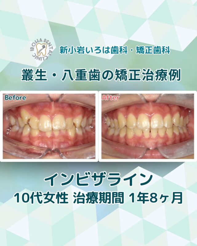 こんにちは。新小岩いろは歯科です🍀

👉今回は、マウスピース矯正による10代患者さま叢生・八重歯の治療例をご紹介しました。

✨ 中高生の今こそ、矯正のチャンス！ ✨

13〜18歳のあごはまだ成長途中。
この時期に矯正を始めることで、骨の成長力を最大限に活かし、歯をスムーズに理想の位置へ導くことができます。

✅歯が動きやすく、抜歯せずに済む場合も
✅歯ぐきへの負担が少ない
✅将来もお口の健康を守りやすい

🟢見た目だけじゃない、一生の健康と自信を贈る治療

透明マウスピース「インビザライン」なら、目立ちにくく、部活や学校生活もそのまま続けられます。

当院では、目立ちにくい「マウスピース矯正（インビザライン）」や、気になる部分だけを整える「部分矯正」など、患者様のライフスタイルに合った治療法を提案しています。

🟢 不安な方には「矯正無料相談」から
「費用はどれくらいかかるの？」
「自分の歯並びでも治せるの？」

そんな疑問や不安に寄り添うために、当院では矯正無料相談を行っています。

当院では、患者さん一人ひとりの歯並びやライフスタイルに合わせた治療計画をご提案し、疑問や不安に丁寧に耳を傾け、一つひとつ解消していきます。歯並びは本当に人それぞれなので、ぜひ一度お気軽にご相談ください💫

矯正治療を受けるにあたり、ご不安に思っていることや疑問点などございましたら、お気軽にご相談ください🍀

無料相談はプロフィールリンクから💡🌸

@shinkoiwairoha.dc
┈ ┈ ┈┈ ┈ ┈ ┈ ┈┈ ┈ ┈┈ ┈ ┈ ┈ ┈
新小岩いろは歯科・矯正歯科🦷✨
📞03-6231-5751

【公式HP】
https://shinkoiwa-iroha-dc.jp/

@shinkoiwairoha.dc

📍JR新小岩駅徒歩2分　第28東ビル3F
⌚診療時間 ｜ 月〜土 9:00〜17:00
休診日：日曜・祝日
┈ ┈ ┈ ┈ ┈ ┈ ┈ ┈┈ ┈ ┈ ┈ ┈
#新小岩#矯正#小児歯科#小児矯正#歯科口腔外科#新小岩いろは歯科#歯列矯正期間#矯正したい#小児歯科矯正#こども歯ならび#こども矯正#矯正歯科#歯並び#歯ならび#拡大床#マウスピース矯正#大人の歯列矯正#すきっ歯#八重歯治療#八重歯#噛み合わせ#矯正カウンセリング#矯正相談#矯正相談無料