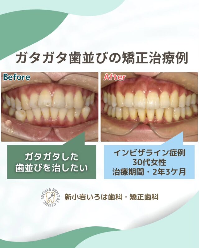 こんにちは。新小岩いろは歯科です🍀

👉今回は、マウスピース矯正による30代患者さま叢生の治療例をご紹介しました。

✨マウスピース矯正で歯と顎のバランスを整える✨

「歯並び、気になるけど…」「痛い？目立つ？」「抜歯しないとダメ？」
そう思ってなかなか一歩を踏み出せない方へ。

歯が並びきらずに重なってしまう「乱ぐい歯」。これは、歯の大きさと顎の大きさのアンバランスが原因で起こることが多いです。マウスピース矯正は、このバランスを整え、歯を適切な位置に導くことで、見た目も機能も美しい歯並びを実現します。

🦷 マウスピース矯正なら――
・透明だから気づかれにくい
・歯を抜かずに治療できるケースも多い
・少しずつ動かすから痛みも少なめ

治療後には、自然に笑いたくなるほどきれいな歯並びに✨

迷っている今こそ、未来の自分のための第一歩を。
「やってよかった」と思える瞬間が必ず訪れます。

そんな疑問や不安に寄り添うために、当院では矯正無料相談を行っています。

当院では、患者さん一人ひとりの歯並びやライフスタイルに合わせた治療計画をご提案し、疑問や不安に丁寧に耳を傾け、一つひとつ解消していきます。歯並びは本当に人それぞれなので、ぜひ一度お気軽にご相談ください💫

矯正治療を受けるにあたり、ご不安に思っていることや疑問点などございましたら、お気軽にご相談ください🍀

無料相談はプロフィールリンクから💡🌸

@shinkoiwairoha.dc
┈ ┈ ┈┈ ┈ ┈ ┈ ┈┈ ┈ ┈┈ ┈ ┈ ┈ ┈
新小岩いろは歯科・矯正歯科🦷✨
📞03-6231-5751

【公式HP】
https://shinkoiwa-iroha-dc.jp/

@shinkoiwairoha.dc

📍JR新小岩駅徒歩2分　第28東ビル3F
⌚診療時間 ｜ 月〜土 9:00〜17:00
休診日：日曜・祝日
┈ ┈ ┈ ┈ ┈ ┈ ┈ ┈┈ ┈ ┈ ┈ ┈
#新小岩#矯正#小児歯科#小児矯正#歯科口腔外科#新小岩いろは歯科#歯列矯正期間#矯正したい#小児歯科矯正#こども歯ならび#こども矯正#矯正歯科#歯並び#歯ならび#拡大床#マウスピース矯正#大人の歯列矯正#すきっ歯#八重歯治療#八重歯#噛み合わせ#矯正カウンセリング#矯正相談#矯正相談無料