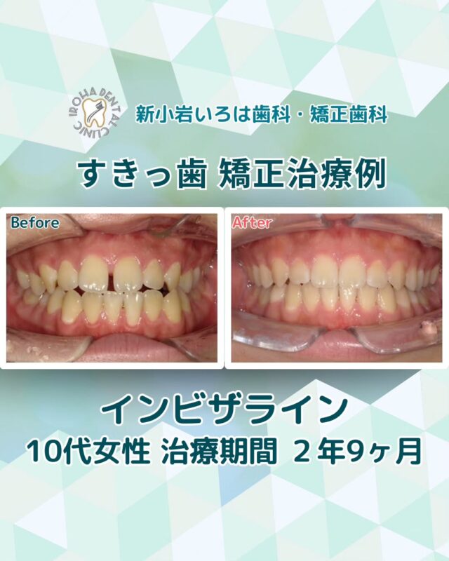 こんにちは。新小岩いろは歯科です🍀

お子さまの前歯にすき間があると、
「このまま自然に治るのかな？」
「矯正が必要なのかな？」と、不安に思う親御さんも多いのではないでしょうか。

実は、乳歯の時期によく見られる「すきっ歯」には、自然に治るケースもあれば、注意が必要なケースもあります。
放っておくと将来的に歯並びや噛み合わせに影響してしまうことも…。

👉その判断を一人で抱える必要はありません。

当院では、矯正歯科の指導医が、お子さまの成長や歯並びの状態を丁寧に診査・診断し、将来を見据えた治療をご提案します。

「今、矯正が必要なのか」「もう少し様子を見てもいいのか」――

一緒に考えていきましょう。

「このまま様子を見ていいのかな？」
「ほかの医院とどう違うのかな？」

そんな疑問を抱える親御さんこそ、ぜひ一度ご相談ください。
お子さまの未来の笑顔に直結する、大切な一歩を一緒に考えましょう😊✨

🟢 不安な方には「矯正無料相談」から
「費用はどれくらいかかるの？」
「自分の歯並びでも治せるの？」

そんな疑問や不安に寄り添うために、当院では矯正無料相談を行っています。

当院では、患者さん一人ひとりの歯並びやライフスタイルに合わせた治療計画をご提案し、疑問や不安に丁寧に耳を傾け、一つひとつ解消していきます。歯並びは本当に人それぞれなので、ぜひ一度お気軽にご相談ください💫

無料相談はプロフィールリンクから💡🌸

@shinkoiwairoha.dc
┈ ┈ ┈┈ ┈ ┈ ┈ ┈┈ ┈ ┈┈ ┈ ┈ ┈ ┈
新小岩いろは歯科・矯正歯科🦷✨
📞03-6231-5751

【公式HP】
https://shinkoiwa-iroha-dc.jp/

@shinkoiwairoha.dc

📍JR新小岩駅徒歩2分　第28東ビル3F
⌚診療時間 ｜ 月〜土 9:00〜17:00
休診日：日曜・祝日
┈ ┈ ┈ ┈ ┈ ┈ ┈ ┈┈ ┈ ┈ ┈ ┈
#新小岩#矯正#小児歯科#小児矯正#歯科口腔外科#新小岩いろは歯科#歯列矯正期間#矯正したい#小児歯科矯正#こども歯ならび#こども矯正#矯正歯科#歯並び#歯ならび#拡大床#マウスピース矯正#大人の歯列矯正#すきっ歯#すきっ歯矯正#すきっ歯治療#噛み合わせ#矯正カウンセリング#矯正相談#矯正相談無料
