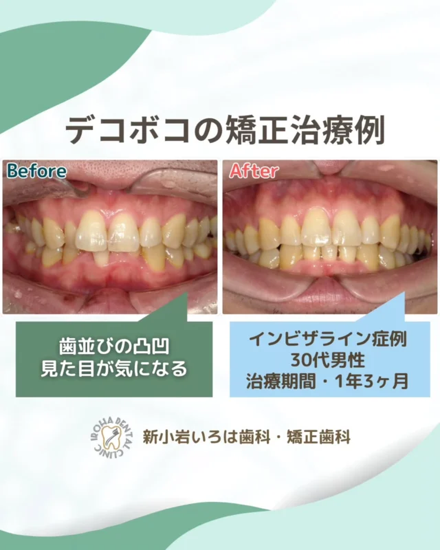 こんにちは。新小岩いろは歯科です🍀

👉今回は、マウスピース矯正による30代患者さま、でこぼこ歯並びの治療例をご紹介しました。

「歯並びを治したいけど、抜歯が必要になるのが怖くて一歩踏み出せない…」 「目立たないインビザラインで、本当に私のガタガタは治るの？」

成人矯正（13歳頃以降の矯正）では、顎の成長が終了しているため、「いかに隙間を確保するか」が治療成功の鍵となります。

だからこそ、叢生（デコボコ）の治療においては、抜歯の要否を必ず検討しなければなりません。

🚨 知っておいてほしい「抜歯・非抜歯」の真実

「なるべく歯を抜きたくない」：その気持ち、よく分かります。もちろん、まずは非抜歯での治療を検討します。

医学的根拠が必須：叢生の原因が骨格にある場合など、抜歯が必要な方を無理に非抜歯で進めると、かえって噛み合わせが悪くなるリスクがあります。

💬だからこそ、まずは無料相談で最適な道を一緒に探してみませんか？

・非抜歯で治療できる可能性は?
・抜歯が必要な場合、その理由は?
・どんな治療法があるのか?矯正を専門とする医師による正確な診断が何よりも重要です。

🌟 後悔しない医院選びのポイント

当院では、矯正を専門とする歯科医師が、医学的な根拠に基づき、あなたの顎の大きさ、骨格、そしてご希望（「抜きたくない」という思い）を複合的に考慮して判断しています。

大切なのは、治療前に「なぜ抜歯が必要なのか（または不必要か）」をしっかりと説明を受け、納得した上で治療に進むことです。

「抜歯を勧められたらどうしよう…」と悩むよりも、まずは専門医に相談して、あなたの状態を知ることが解決への最短ルートです。

🟢 不安な方には「矯正無料相談」から
「費用はどれくらいかかるの？」
「自分の歯並びでも治せるの？」

そんな疑問や不安に寄り添うために、当院では矯正無料相談を行っています。

当院では、患者さん一人ひとりの歯並びやライフスタイルに合わせた治療計画をご提案し、疑問や不安に丁寧に耳を傾け、一つひとつ解消していきます。歯並びは本当に人それぞれなので、ぜひ一度お気軽にご相談ください💫

無料相談はプロフィールリンクから💡🌸

@shinkoiwairoha.dc
┈ ┈ ┈┈ ┈ ┈ ┈ ┈┈ ┈ ┈┈ ┈ ┈ ┈ ┈
新小岩いろは歯科・矯正歯科🦷✨
📞03-6231-5751

【公式HP】
https://shinkoiwa-iroha-dc.jp/

@shinkoiwairoha.dc

📍JR新小岩駅徒歩2分　第28東ビル3F
⌚診療時間 ｜ 月〜土 9:00〜17:00
休診日：日曜・祝日
┈ ┈ ┈ ┈ ┈ ┈ ┈ ┈┈ ┈ ┈ ┈ ┈
#新小岩いろは歯科#新小岩#矯正#小児歯科#小児矯正#歯科口腔外科#歯列矯正期間#矯正したい#小児歯科矯正#こども歯ならび#こども矯正#矯正歯科#矯正歯科選び#歯並び#歯ならび#拡大床#マウスピース矯正#インビザライン#叢生#歯並びコンプレックス#大人の歯列矯正#すきっ歯#すきっ歯矯正#歯並びガタガタ#噛み合わせ#矯正カウンセリング#矯正相談#矯正相談無料#矯正相談受付中