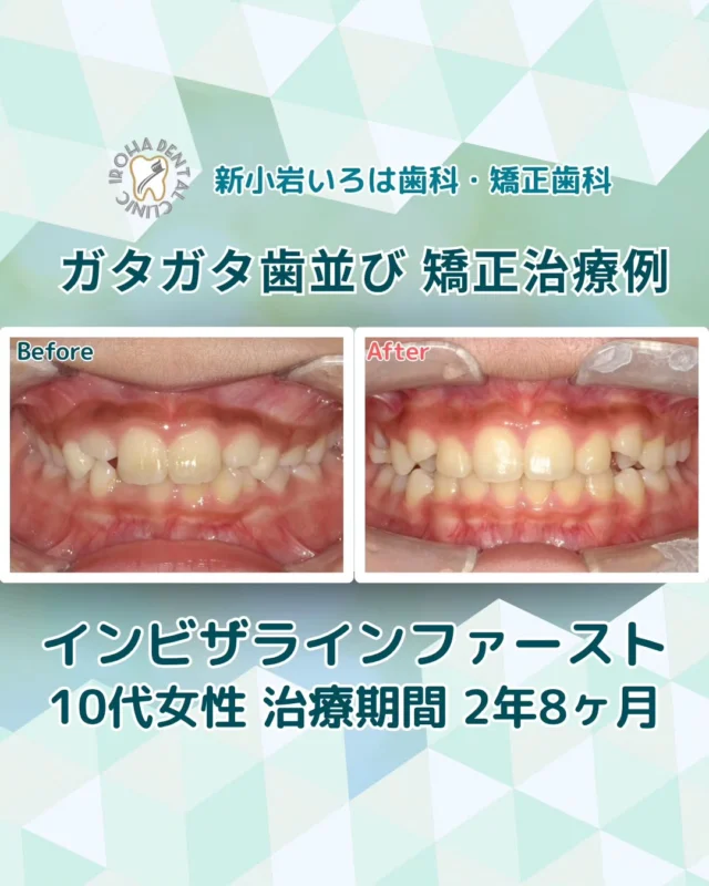 こんにちは。新小岩いろは歯科です🍀

👉今回は、マウスピース矯正による10代患者さま、でこぼこ歯並びの治療例をご紹介しました。

６〜１０歳のママパパ必見！
【目立たない子どもの矯正とは】

「うちの子の歯並び、いつ矯正を始めたらいいの？」

そのお悩み、乳歯と永久歯が混在する6歳〜10歳前後の「今」が、実は一番大切なタイミングかもしれません！✨

従来の矯正装置（拡大床など）に抵抗があるお子様、そして保護者の方へ。
目立たないマウスピース矯正「インビザライン・ファースト」が、子どもの矯正（１期治療）の課題を解決します！

🌟 インビザライン・ファーストのココがすごい！

✅目立たない！見た目問題クリア

従来の固定式装置と比べて透明で目立ちにくいため、お友達にも気づかれにくいのが最大のメリット。お子様も自信を持って学校生活を送れます！

✅快適・衛生的！

食事や歯磨きは自分で取り外しOK。口の中を傷つけにくく、いつも通りにしっかり磨けるから、虫歯リスクも軽減できます。

✅安心の「見える化」機能

ちゃんと装着しているか不安なママパパも安心！特別デザインの装置は、装着時間に応じて色が変化するので、お子様と一緒に管理できます🙌

✅成長に合わせてオーダーメイド

大人用とは違い、これから生えてくる永久歯にも対応できるよう改良されています。成長期だからこそできる、骨格と歯並び両方へのアプローチをサポート！

⚠️ こんな疑問、一人で悩まないで！
「うちの子は矯正が必要？」
「費用はどれくらいかかるの？」

子どもの矯正は、タイミングが重要です。手遅れになる前に、まずは専門家にご相談ください。ドクターとスタッフが、お子様の将来の笑顔のためにしっかりサポートします。

👉 無料相談受付中！ 新小岩いろは歯科は、新小岩駅徒歩１分で通いやすさも抜群です。

🟢 不安な方には「矯正無料相談」から

「費用はどれくらいかかるの？」
「自分の歯並びでも治せるの？」

そんな疑問や不安に寄り添うために、当院では矯正無料相談を行っています。

当院では、患者さん一人ひとりの歯並びやライフスタイルに合わせた治療計画をご提案し、疑問や不安に丁寧に耳を傾け、一つひとつ解消していきます。歯並びは本当に人それぞれなので、ぜひ一度お気軽にご相談ください💫

無料相談はプロフィールリンクから💡🌸

@shinkoiwairoha.dc
┈ ┈ ┈┈ ┈ ┈ ┈ ┈┈ ┈ ┈┈ ┈ ┈ ┈ ┈
新小岩いろは歯科・矯正歯科🦷✨
📞03-6231-5751

【公式HP】
https://shinkoiwa-iroha-dc.jp/

@shinkoiwairoha.dc

📍JR新小岩駅徒歩2分　第28東ビル3F
⌚診療時間 ｜ 月〜土 9:00〜17:00
休診日：日曜・祝日
┈ ┈ ┈ ┈ ┈ ┈ ┈ ┈┈ ┈ ┈ ┈ ┈
#新小岩いろは歯科#新小岩#新小岩歯医者#新小岩駅近#小児歯科#小児矯正#歯科口腔外科#歯列矯正期間#矯正したい#小児歯科矯正#こども歯ならび#こども矯正#矯正歯科#矯正歯科選び#歯並び#歯ならび#拡大床#マウスピース矯正#インビザライン#叢生#歯並びコンプレックス#大人の歯列矯正#すきっ歯#すきっ歯矯正#歯並びガタガタ#噛み合わせ#矯正カウンセリング#矯正相談#矯正相談無料#矯正相談受付中