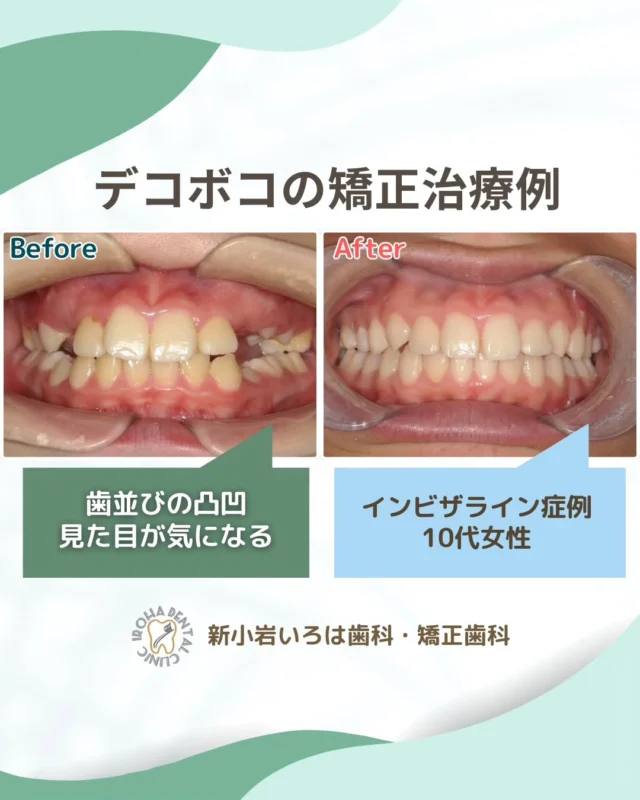 👉今回は、マウスピース矯正による10代患者さまの叢生（でこぼこ歯並び）治療例をご紹介しました。

✨ 中高生の今こそ、矯正のチャンス！ ✨

13〜18歳のあごはまだ成長途中。
この時期に矯正をスタートすることで、骨の成長力を最大限に活かし、歯をスムーズに理想の位置へ導くことができます。

✅ 歯が動きやすく、抜歯せずに済む場合も
✅ 歯ぐきへの負担が少ない
✅ 将来のお口の健康を守りやすい

🟢見た目だけじゃない、「一生の健康」と「笑顔への自信」を贈る治療

透明マウスピース〈インビザライン〉なら、目立ちにくいので学校生活や部活もそのまま続けられます。

「中学生の矯正は遅い？」「子供の歯並びの相談をしたい」そんなお声にも丁寧にお応えします。

当院では、
◎目立ちにくいマウスピース矯正（インビザライン）
◎気になる部分だけ整える部分矯正
など、生活スタイルや成長段階に合わせた治療をご提案しています。

📍新小岩・葛飾区で子供の歯並び矯正を考えている方
📍中学生・思春期のお子さまの口元が気になる方
📍マウスピース矯正を検討している方

お気軽にご相談ください。

「改善できるのかな？」という最初の一歩から、私たちがお手伝いします🌱

🟢 不安な方には「矯正無料相談」から
「費用はどれくらいかかるの？」
「自分の歯並びでも治せるの？」

そんな疑問や不安に寄り添うために、当院では矯正無料相談を行っています。

当院では、患者さん一人ひとりの歯並びやライフスタイルに合わせた治療計画をご提案し、疑問や不安に丁寧に耳を傾け、一つひとつ解消していきます。歯並びは本当に人それぞれなので、ぜひ一度お気軽にご相談ください💫

矯正治療を受けるにあたり、ご不安に思っていることや疑問点などございましたら、お気軽にご相談ください🍀

無料相談はプロフィールリンクから💡🌸

@shinkoiwairoha.dc
┈ ┈ ┈┈ ┈ ┈ ┈ ┈┈ ┈ ┈┈ ┈ ┈ ┈ ┈
新小岩いろは歯科・矯正歯科🦷✨
📞03-6231-5751

【公式HP】
https://shinkoiwa-iroha-dc.jp/

@shinkoiwairoha.dc

📍JR新小岩駅徒歩2分　第28東ビル3F
⌚診療時間 ｜ 月〜土 9:00〜17:00
休診日：日曜・祝日
┈ ┈ ┈ ┈ ┈ ┈ ┈ ┈┈ ┈ ┈ ┈ ┈
#新小岩 #葛飾区 #新小岩いろは歯科 #葛飾区歯並び相談 #歯並び相談
#矯正 #矯正歯科 #小児歯科 #小児矯正 #小児歯科矯正 #歯並び #こども歯ならび #子供歯並び #叢生  #八重歯治療 #噛み合わせ #すきっ歯 #マウスピース矯正 #インビザライン #中学生マウスピース矯正 #10代矯正 #抜歯なし矯正 #拡大床
#矯正したい #大人の歯列矯正 #歯列矯正期間 #成長期
#矯正相談 #矯正相談無料 #矯正カウンセリング