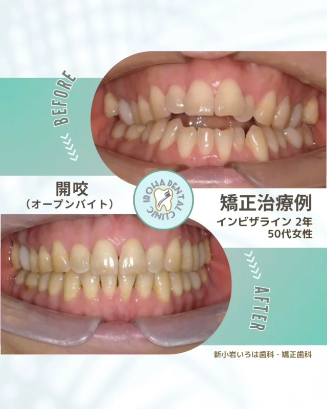 こんにちは。新小岩いろは歯科です🍀

👉今回は、マウスピース矯正による50代患者さまの治療例をご紹介しました。

開咬は見た目の問題だけでなく
・食事で上手く噛み切れない
・発音・滑舌が悪くなる
・奥歯だけに負担がかかる
といった生活の不調にもつながります。

「気になるけど矯正って痛い？大変？」
そんな不安を抱えたまま、何年も悩み続けてしまう方も少なくありません。

でも大丈夫。
インビザライン矯正なら、透明のマウスピースで目立ちにくく、普段通りの生活をしながら
前歯の噛み合わせ（開咬）にもアプローチできます✨
治療前から治療後までの変化もシミュレーションで確認できるから安心。

当院では、まず無料の矯正相談からスタート。
「前歯が噛み合わない」「開咬を治したい」などのお悩みを丁寧に伺い、
レントゲンや口腔内資料を使った分析も可能です。
治療を無理にすすめることはありませんのでご安心ください🍀

📍 新小岩いろは歯科・矯正歯科では、

開咬（オープンバイト）の矯正をはじめ、歯列矯正や噛み合わせのご相談にも幅広く対応しています。

「どこに相談したらいいか迷っていた」
そんな方にこそ選んでほしい、おすすめできるサポート体制で不安のない矯正治療を大切にしています。

食べる・話す・笑うをもっと快適に。
未来の自分のために、一度ご相談からはじめませんか？🕊

無料矯正相談・セカンドオピニオンは随時受付中（予約制）📩
「まずは話だけ聞きたい」も大歓迎です。

「いつから始めるべき？」「自分に合うの？」— どんな疑問でも構いません。
将来の笑顔と自信のために、まずはお気軽にご相談ください😊

そんな疑問や不安に寄り添うために、当院では矯正無料相談を行っています。

当院では、患者さん一人ひとりの歯並びやライフスタイルに合わせた治療計画をご提案し、疑問や不安に丁寧に耳を傾け、一つひとつ解消していきます。歯並びは本当に人それぞれなので、ぜひ一度お気軽にご相談ください💫

矯正治療を受けるにあたり、ご不安に思っていることや疑問点などございましたら、お気軽にご相談ください🍀

LINEで24時間受付中！無料相談はプロフィールリンクから💡🌸

@shinkoiwairoha.dc
┈ ┈ ┈┈ ┈ ┈ ┈ ┈┈ ┈ ┈┈ ┈ ┈ ┈ ┈
新小岩いろは歯科・矯正歯科🦷✨
📞03-6231-5751

【公式HP】
https://shinkoiwa-iroha-dc.jp/

@shinkoiwairoha.dc

📍JR新小岩駅徒歩2分　第28東ビル3F
⌚診療時間 ｜ 月〜土 9:00〜17:00
休診日：日曜・祝日
┈ ┈ ┈ ┈ ┈ ┈ ┈ ┈┈ ┈ ┈ ┈ ┈
#新小岩#矯正#小児歯科#小児矯正#歯科口腔外科#新小岩いろは歯科#歯列矯正期間#矯正したい#小児歯科矯正#こども歯ならび#こども矯正#矯正歯科#歯並び#過蓋咬合#深いかみ合わせ#噛み合わせ改善#かみ合わせ治療#咬合治療#拡大床#マウスピース矯正#大人の歯列矯正#開咬 #開咬矯正 #前歯が噛み合わない#矯正経過#矯正カウンセリング#矯正相談#矯正相談無料