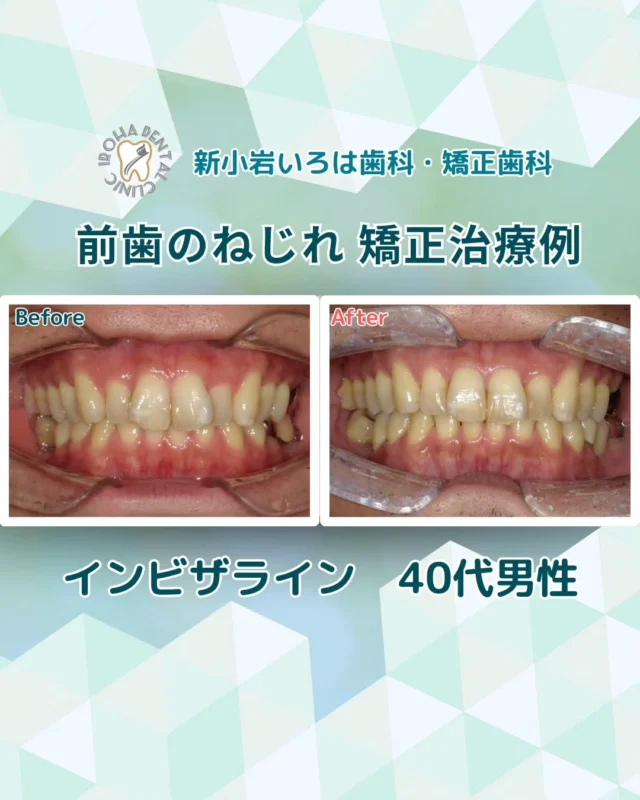 こんにちは。新小岩いろは歯科です🍀

👉今回は、マウスピース矯正での前歯のねじれの治療例をご紹介しました。

「ハの字状に生えている前歯」「ねじれのある歯並び」...そんな前歯のお悩み、抱えていませんか？

💡「前歯だけ矯正したいけど全顎矯正になるの？」と戸惑い、治療を迷っているうちに時間が過ぎてしまったという方は少なくありません。

この「ねじれ」は、見た目だけでなく、実は将来のお口の健康にも関わってきます。しかし、「矯正って大掛かりになりそう…」と不安に感じるかもしれませんね。

翼状捻転の治療方法は、症状の度合いによって様々です。軽度であれば部分的な矯正装置で済む場合もありますし、中程度や重度の場合は、歯を並べるためのスペース確保が必要になることもあります

🗣️ まずは無料カウンセリングで全てを明確に！
「新小岩 歯並びをきれいにしたい」けれど、どの治療法が良いか迷っている方へ。

当院では、あなたの歯並びの状態を詳しく診断し、最適な治療法をご提案します。新小岩 矯正歯科で豊富な経験を持つ当院に、まずはお気軽にご相談ください。

「私の場合、部分矯正でインビザライン矯正ができる？」「費用はいくら？」といった疑問も、無料カウンセリングで全て解消しましょう。💡

当院では、あなたの歯並びの状態を詳しく拝見し、どのような変化が期待できるのか、最適な治療法は何かを丁寧にご説明いたします🦷✨

悩みを抱え込まずに、ぜひ一度、お気軽にご相談ください。
あなたの未来の笑顔を、一緒にデザインしましょう🌈

矯正治療を受けるにあたり、ご不安に思っていることや疑問点などございましたら、お気軽にご相談ください🍀

無料相談はプロフィールリンクから💡🌸

@shinkoiwairoha.dc
┈ ┈ ┈┈ ┈ ┈ ┈ ┈┈ ┈ ┈┈ ┈ ┈ ┈ ┈
新小岩いろは歯科・矯正歯科🦷✨
📞03-6231-5751

【公式HP】
https://shinkoiwa-iroha-dc.jp/

@shinkoiwairoha.dc

📍JR新小岩駅徒歩2分　第28東ビル3F
⌚診療時間 ｜ 月〜土 9:00〜17:00
休診日：日曜・祝日
┈ ┈ ┈ ┈ ┈ ┈ ┈ ┈┈ ┈ ┈ ┈ ┈
#新小岩いろは歯科#新小岩#矯正#小児歯科#小児矯正#歯科口腔外科#歯列矯正期間#矯正したい#小児歯科矯正#こども歯ならび#こども矯正#矯正歯科#歯並び#歯ならび#拡大床#マウスピース矯正#大人の歯列矯正#噛み合わせ#矯正カウンセリング#歯科矯正費用#矯正相談#矯正相談無料