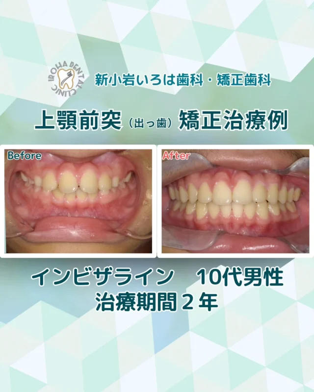 こんにちは。新小岩いろは歯科です🍀

👉今回は、10代の患者様のマウスピース矯正治療例をご紹介しました。

💡まだ間に合う？お子様の「出っ歯」気になり始めたら、今がその時です🦷✨

仕上げ磨きの時や、ふとした瞬間の横顔を見て… 「うちの子、前歯が出ている気がする」「歯並び悪いかも…」「永久歯が生えてきたらガタガタ歯になってきた💦」

そんな不安を感じたことはありませんか？

実はその「子どもの出っ歯（子供の出っ歯）」、放置すると自然に治ることは少なく、成長とともに治療が難しくなってしまうことが多いんです。

原因は、指しゃぶりや「お口ぽかん（口呼吸）」、そして遺伝によるあごの小ささなど様々。 上あごが十分に成長しないままだと、将来的に健康な歯を抜いて矯正しなければならなくなるリスクが高まります⚡️

でも、大丈夫です。 成長期の今だからこそ、できることがあります🌱

🏆 治療開始のベストタイミングは【6歳ごろ】！ 7〜8歳のお子様は、まさに「今すぐ」が始めどきです。 あごの成長を利用して広げることで、非抜歯でお顔立ちごと整えられる可能性がグッと高まります✨

「うちの子の場合、インビザラインなどのマウスピース矯正はできる？」 「期間や費用は具体的にどれくらい？」

ネットで調べるだけでは分からないその疑問、新小岩で豊富な実績を持つ当院にお任せください👨‍⚕️

まずは一度、無料カウンセリングで現状をクリアにしませんか？ お子様のお口の状態を詳しく診断し、最適な治療法と将来の変化について丁寧にシミュレーションいたします💡

当院では、あなたの歯並びの状態を詳しく拝見し、どのような変化が期待できるのか、最適な治療法は何かを丁寧にご説明いたします🦷✨

悩みを抱え込まずに、ぜひ一度、お気軽にご相談ください。
あなたの未来の笑顔を、一緒にデザインしましょう🌈

矯正治療を受けるにあたり、ご不安に思っていることや疑問点などございましたら、お気軽にご相談ください🍀

無料相談はプロフィールリンクから💡🌸

@shinkoiwairoha.dc
┈ ┈ ┈┈ ┈ ┈ ┈ ┈┈ ┈ ┈┈ ┈ ┈ ┈ ┈
新小岩いろは歯科・矯正歯科🦷✨
📞03-6231-5751

【公式HP】
https://shinkoiwa-iroha-dc.jp/

@shinkoiwairoha.dc

📍JR新小岩駅徒歩2分　第28東ビル3F
⌚診療時間 ｜ 月〜土 9:00〜17:00
休診日：日曜・祝日
┈ ┈ ┈ ┈ ┈ ┈ ┈ ┈┈ ┈ ┈ ┈ ┈
#新小岩いろは歯科#新小岩#矯正#小児歯科#小児矯正#歯科口腔外科#歯列矯正期間#矯正したい#小児歯科矯正#こども歯ならび#こども矯正#矯正歯科#歯並び#歯ならび#子供の出っ歯 #口呼吸#拡大床#マウスピース矯正#大人の歯列矯正#噛み合わせ#子どもの出っ歯#矯正カウンセリング#歯科矯正費用#矯正相談#矯正相談無料