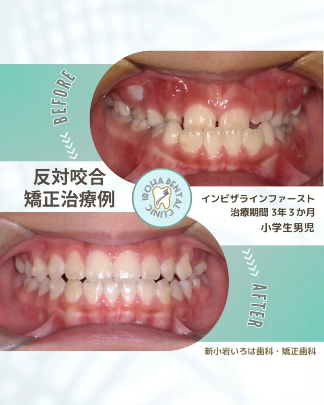 こんにちは。新小岩いろは歯科です🍀

👉今回は、マウスピース矯正による小学生の治療例をご紹介しました。

【そのまま様子見…本当に大丈夫ですか？】

「まだ小さいし、いずれ治るかも」
「様子を見てからでも遅くないよね」

――そう思っている間に、反対咬合（受け口）は成長とともに“静かに進行”していくことがあります。

✔ 下顎が思春期に急成長して悪化
✔ 発音や噛む力への影響
✔ 顔立ちへのコンプレックス
✔ 大人になってから外科手術が必要になるケースも…

実は、こどものうちだからこそできる治療があります。
顎の成長を味方につければ、抜歯や手術を避けられる可能性も高まります。

「本格矯正が必要なのか知りたい」
「今すぐ治療すべき？」
「癖や舌の使い方も関係している？」

――そんな“相談だけ”大丈夫です。

お子さまの将来のために、
後悔しない選択をする第一歩として、まずはお気軽にご相談ください。

💡受け口は見た目だけの問題ではありません。 

空気の通り道が狭くなり、口呼吸が定着すると、風邪を引きやすくなったり、集中力が低下したり…心身の発達にも影響が出てしまいます。

当院では、単に歯を並べるだけでなく、🌟「マイオブレース」 を使って、口周りの筋肉トレーニングや悪習癖の改善も行います。

根本的な原因である「癖」を治すことで、矯正後の「後戻り」も防ぎ、健康な呼吸を手に入れることができます！

「まだ早いかな？」と思う年齢でも、癖の改善は早ければ早いほど良いです。 金属を使わないマウスピース矯正など、お子様の負担が少ない方法もご提案できます。

まずは「癖のチェック」だけでも、お越しくださいね🦷✨

無料矯正相談・セカンドオピニオンは随時受付中（予約制）📩
「まずは話だけ聞きたい」も大歓迎です。

「いつから始めるべき？」「いまの歯並びで、大丈夫？」— どんな疑問でも構いません。
将来の笑顔と自信のために、まずはお気軽にご相談ください😊

そんな疑問や不安に寄り添うために、当院では矯正無料相談を行っています。

当院では、患者さん一人ひとりの歯並びやライフスタイルに合わせた治療計画をご提案し、疑問や不安に丁寧に耳を傾け、一つひとつ解消していきます。歯並びは本当に人それぞれなので、ぜひ一度お気軽にご相談ください💫

矯正治療を受けるにあたり、ご不安に思っていることや疑問点などございましたら、お気軽にご相談ください🍀

LINEで24時間受付中！無料相談はプロフィールリンクから💡🌸

@shinkoiwairoha.dc
┈ ┈ ┈┈ ┈ ┈ ┈ ┈┈ ┈ ┈┈ ┈ ┈ ┈ ┈
新小岩いろは歯科・矯正歯科🦷✨
📞03-6231-5751

【公式HP】
https://shinkoiwa-iroha-dc.jp/

@shinkoiwairoha.dc

📍JR新小岩駅徒歩2分　第28東ビル3F
⌚診療時間 ｜ 月〜土 9:00〜17:00
休診日：日曜・祝日
┈ ┈ ┈ ┈ ┈ ┈ ┈ ┈┈ ┈ ┈ ┈ ┈
#新小岩#矯正#小児歯科#小児矯正#歯科口腔外科#新小岩いろは歯科#歯列矯正期間#矯正したい#小児歯科矯正#こども歯ならび#こども矯正#矯正歯科#歯並び#過蓋咬合#深いかみ合わせ#噛み合わせ改善#かみ合わせ治療#咬合治療#拡大床#マウスピース矯正#子供の癖 #指しゃぶり #口呼吸 #前歯が噛み合わない#受け口改善#矯正経過#矯正カウンセリング#矯正相談#矯正相談無料