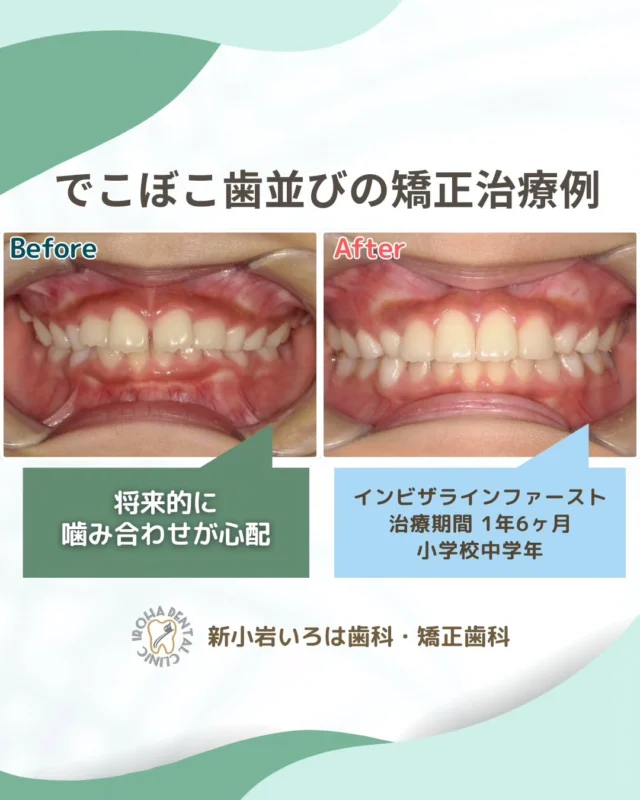 👉今回は、マウスピース矯正による10代患者さまの叢生（でこぼこ歯並び）治療例をご紹介しました。

透明で目立たない！学校生活も安心の「インビザライン・ファースト」って？🦷✨

「子どもの歯並び、治してあげたいけどワイヤーは可哀想…」 「学校で友達にからかわれないか心配…」

そんな保護者様の悩みを解消する、子ども専用のマウスピース矯正「インビザライン・ファースト」をご存知ですか？🤔

これは乳歯と永久歯が混ざり合う時期（混合歯列期）だからこそできる、お子様の「成長する力」を利用した治療法です🌱

👨‍👩‍👧選ばれている5つのポイント
✅ とにかく目立たない 透明だから学校生活でも気づかれにくく、見た目を気にするお子様も抵抗なく始められます🏫

✅ ご飯も歯磨きも普段通り 食事やブラッシングの時は取り外しOK！給食も美味しく食べられて、虫歯リスクも抑えられます🍔

✅ 将来の抜歯リスクを減らす 顎の成長をサポートして歯が並ぶスペース（土台）を広げることで、将来、健康な歯を抜かずに済む可能性が高まります✨

✅ 親子で取り組む矯正 取り外しができる分、ご家庭での管理が成功のカギ🗝️ 大変なこともありますが、親子で二人三脚で手に入れた歯並びは、一生の宝物になります💎

🟢 不安な方には「矯正無料相談」から
「費用はどれくらいかかるの？」
「自分の歯並びでも治せるの？」

そんな疑問や不安に寄り添うために、当院では矯正無料相談を行っています。

当院では、患者さん一人ひとりの歯並びやライフスタイルに合わせた治療計画をご提案し、疑問や不安に丁寧に耳を傾け、一つひとつ解消していきます。歯並びは本当に人それぞれなので、ぜひ一度お気軽にご相談ください💫

矯正治療を受けるにあたり、ご不安に思っていることや疑問点などございましたら、お気軽にご相談ください🍀

無料相談はプロフィールリンクから💡🌸

@shinkoiwairoha.dc
┈ ┈ ┈┈ ┈ ┈ ┈ ┈┈ ┈ ┈┈ ┈ ┈ ┈ ┈
新小岩いろは歯科・矯正歯科🦷✨
📞03-6231-5751

【公式HP】
https://shinkoiwa-iroha-dc.jp/

@shinkoiwairoha.dc

📍JR新小岩駅徒歩2分　第28東ビル3F
⌚診療時間 ｜ 月〜土 9:00〜17:00
休診日：日曜・祝日
┈ ┈ ┈ ┈ ┈ ┈ ┈ ┈┈ ┈ ┈ ┈ ┈
#新小岩いろは歯科#歯ならび#マウスピース矯正#噛み合わせ#矯正相談無料