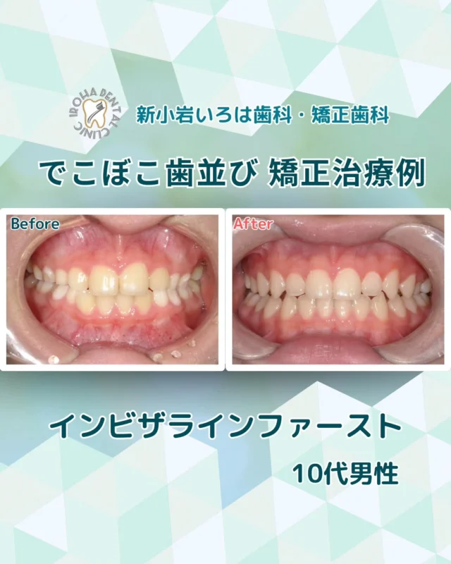 こんにちは。新小岩いろは歯科です🍀

👉今回は、マウスピース矯正による小学生の患者さまの治療例をご紹介しました。

「歯並びは気になるけど、
矯正を嫌がって通ってくれない…」

「毎日の装置の管理、
ちゃんと続けられるか不安…」

そんなお悩み、実はとても多いです。

子どもの矯正治療は
“本人の気持ち”がとても大切。
どんなに良い治療でも、
続けられなければ意味がありません。

だからこそ当院では、
「続けやすさ」を大切にした
子どもの矯正治療も行っています。

✨インビザライン・ファーストが
続けやすい理由✨

✔ 透明で目立ちにくい
✔ 取り外しできて食事制限なし
✔ 歯磨きしやすく虫歯リスクが低い
✔ 薄くて違和感が少ない
✔ 顎の成長をサポート
✔ 永久歯の生え方まで考えた設計

「つけなきゃダメ！」ではなく、
生活に自然になじむことが
続けられる一番のポイントです。

「うちの子、できるかな…？」
「矯正が嫌いにならないか心配…」

そんな方こそ、
インビザライン・ファーストという選択を
知ってほしいと思っています。

まずは相談だけでも大丈夫です。
お子さまの性格や生活に合わせて、
無理のない方法をご提案します🦷✨

無料矯正相談・セカンドオピニオンは随時受付中（予約制）📩
「まずは話だけ聞きたい」も大歓迎です。

「いつから始めるべき？」「うちの子に合うの？」— どんな疑問でも構いません。
将来の笑顔と自信のために、まずはお気軽にご相談ください😊

そんな疑問や不安に寄り添うために、当院では矯正無料相談を行っています。

当院では、患者さん一人ひとりの歯並びやライフスタイルに合わせた治療計画をご提案し、疑問や不安に丁寧に耳を傾け、一つひとつ解消していきます。歯並びは本当に人それぞれなので、ぜひ一度お気軽にご相談ください💫

矯正治療を受けるにあたり、ご不安に思っていることや疑問点などございましたら、お気軽にご相談ください🍀

LINEで24時間受付中！無料相談はプロフィールリンクから💡🌸

@shinkoiwairoha.dc
┈ ┈ ┈┈ ┈ ┈ ┈ ┈┈ ┈ ┈┈ ┈ ┈ ┈ ┈
新小岩いろは歯科・矯正歯科🦷✨
📞03-6231-5751

【公式HP】
https://shinkoiwa-iroha-dc.jp/

@shinkoiwairoha.dc

📍JR新小岩駅徒歩2分　第28東ビル3F
⌚診療時間 ｜ 月〜土 9:00〜17:00
休診日：日曜・祝日
┈ ┈ ┈ ┈ ┈ ┈ ┈ ┈┈ ┈ ┈ ┈ ┈
#小児矯正#インビザラインファースト
#子どもの歯並び#マウスピース矯正#矯正相談無料