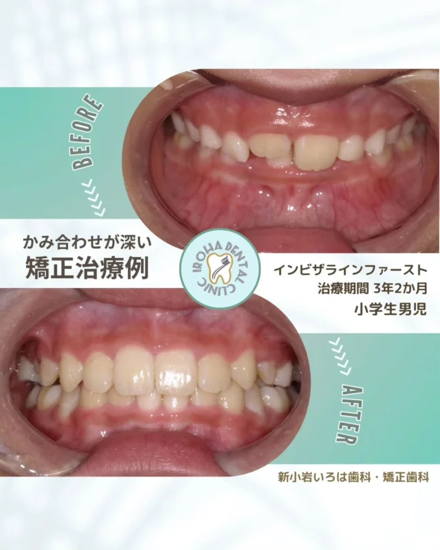 こんにちは。新小岩いろは歯科です🍀

👉今回は、マウスピース矯正による小学生の治療例をご紹介しました。

「うちの子、下の前歯があまり見えないかも…？」 それ、実は「過蓋咬合（かがいこうごう）」という、噛み合わせのサインかもしれません。

別名「ディープバイト」とも呼ばれるこの状態。 一見、歯並びが整っているように見えるため、「様子を見ようかな」と放置されがちですが、実は早めのケアがとっても大切な不正咬合なんです。

⚠️ 放置するとどうなるの？

顎への負担：顎の動きが制限され、将来的に顎関節症（痛みや音）の原因に。

歯ぐきのトラブル：下の前歯が上の歯ぐきを刺激し続け、炎症や歯周病のリスクが高まります。

💡 子供のうちに始めるメリット 大人の矯正との一番の違いは、「骨格から整えられること」です！

 大人になってから骨格を大きく変えるには手術が必要になるケースもありますが、成長期のお子様なら、取り外し可能なマウスピース装置などで、顎の成長を正しくガイドしてあげることが可能です。

「指しゃぶりがなかなか治らない…」といったお悩みも、実は噛み合わせに関係していることがあります。

「まだ乳歯があるから早いかな？」
「本人が痛がっていないから大丈夫？」 と迷っている時間も、お子様の大切な成長期です。

まずは無料相談で、今のお子様の状態をチェックしてみませんか？✨ 
将来、お子様が「健康な顎と歯」で一生美味しく食べられるように、今できるベストなタイミングを一緒に見極めましょう。

無料矯正相談・セカンドオピニオンは随時受付中（予約制）📩
「まずは話だけ聞きたい」も大歓迎です。

「いつから始めるべき？」「いまの歯並びで、大丈夫？」— どんな疑問でも構いません。
将来の笑顔と自信のために、まずはお気軽にご相談ください😊

そんな疑問や不安に寄り添うために、当院では矯正無料相談を行っています。

当院では、患者さん一人ひとりの歯並びやライフスタイルに合わせた治療計画をご提案し、疑問や不安に丁寧に耳を傾け、一つひとつ解消していきます。歯並びは本当に人それぞれなので、ぜひ一度お気軽にご相談ください💫

矯正治療を受けるにあたり、ご不安に思っていることや疑問点などございましたら、お気軽にご相談ください🍀

LINEで24時間受付中！無料相談はプロフィールリンクから💡🌸

@shinkoiwairoha.dc
┈ ┈ ┈┈ ┈ ┈ ┈ ┈┈ ┈ ┈┈ ┈ ┈ ┈ ┈
新小岩いろは歯科・矯正歯科🦷✨
📞03-6231-5751

【公式HP】
https://shinkoiwa-iroha-dc.jp/

@shinkoiwairoha.dc

📍JR新小岩駅徒歩2分　第28東ビル3F
⌚診療時間 ｜ 月〜土 9:00〜17:00
休診日：日曜・祝日
┈ ┈ ┈ ┈ ┈ ┈ ┈ ┈┈ ┈ ┈ ┈ ┈
#小児矯正 #過蓋咬合 #深いかみ合わせ #噛み合わせ改善 #かみ合わせ治療