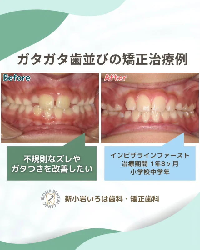 こんにちは！新小岩いろは歯科です🌿

今回は、マウスピース矯正による10代患者さまの叢生（がたがた歯並び）の治療例をご紹介しました。

子どもの歯並びは
「自然に治る」「大人になってから矯正すればいい」
そう思われがちですが、実はそうとは限りません🦷

歯並びもむし歯と同じように、
悪くなる原因に早く気づき、取り除くことで予防・改善が可能です✨

特に大切なのは
👉 3歳〜6歳頃
この時期は、将来の歯並びを左右する大切な成長期。

✔ 乳歯にすき間がない
✔ 永久歯がデコボコしてきた
✔ 口呼吸・指しゃぶりの癖がある

そんなサインがあれば、早めのチェックがおすすめです。

また、子どもの歯並びが悪くなるのは「遺伝」や「運」だけではありません。 昔に比べて子どもの虫歯が激減したように、 歯並びも「原因」を取り除くことで、予防・改善ができるんです✨

🦷 なぜガタガタになるの？ 一番の原因は「スペース不足」です。 大人の歯は、子供の歯よりもひと回り大きいです。 そのため、乳歯の段階で「隙間なくビッシリきれいに」並んでいると、 いざ生え変わる時にスペースが足りず、行き場をなくした永久歯がデコボコに生えてきてしまいます💦

⏰ 見逃さないで！運命の分かれ道 将来の歯並びを左右するのは、 【3歳〜6歳頃】（奥歯が生え揃い、前歯が抜けるまで）です。

この時期に、 
✅ 指しゃぶりや口呼吸などの「癖」はないか？ 
✅ 顎（あご）はしっかり成長しているか？ をチェックし、お家でアプローチすることで、 将来、高額な矯正や抜歯を回避できる可能性がグッと高まります！

もし既に「ガタガタしてきたかも…」と思っても、諦めないでください。 6歳〜9歳頃（混合歯列期）であれば、子どもの「成長する力」を利用して、顎を広げる治療が可能です。

「様子を見よう」と放置してしまい、 大人になってから「歯を抜かないと治せない」となる前に。

虫歯予防と同じように、 歯並びも「悪くなる前のケア」が当たり前の時代です😌

お子様のお口を見て「あれ？」と思ったら、 成長が止まってしまう前に、一度ご相談くださいね🍀

🟢 不安な方には「矯正無料相談」から
「費用はどれくらいかかるの？」
「いまの歯並びでも治せるの？」

そんな疑問や不安に寄り添うために、当院では矯正無料相談を行っています。

当院では、患者さん一人ひとりの歯並びやライフスタイルに合わせた治療計画をご提案し、疑問や不安に丁寧に耳を傾け、一つひとつ解消していきます。歯並びは本当に人それぞれなので、ぜひ一度お気軽にご相談ください💫

矯正治療を受けるにあたり、ご不安に思っていることや疑問点などございましたら、お気軽にご相談ください🍀

無料相談はプロフィールリンクから💡🌸

@shinkoiwairoha.dc
┈ ┈ ┈┈ ┈ ┈ ┈ ┈┈ ┈ ┈┈ ┈ ┈ ┈ ┈
新小岩いろは歯科・矯正歯科🦷✨
📞03-6231-5751

【公式HP】
https://shinkoiwa-iroha-dc.jp/

@shinkoiwairoha.dc

📍JR新小岩駅徒歩2分　第28東ビル3F
⌚診療時間 ｜ 月〜土 9:00〜17:00
休診日：日曜・祝日
┈ ┈ ┈ ┈ ┈ ┈ ┈ ┈┈ ┈ ┈ ┈ ┈
#小児矯正 #子供の歯並び #叢生 #子供の矯正 #生え変わり