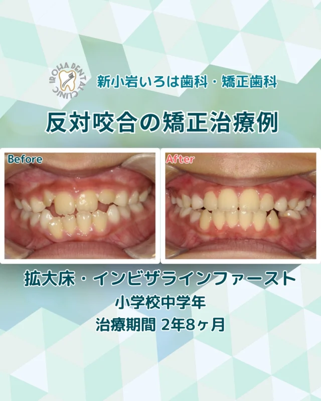 今回は、マウスピース矯正による小学校中学年患者さまの反対咬合（受け口）の治療例をご紹介しました。

「うちの子、受け口かも？」と思ったら。後悔しないためのタイミングの真実
「乳歯だから、永久歯になれば治るかも…」
「まだ小さいし、矯正は早いかな？」

お子様の反対咬合（受け口）に気づきながらも、一歩踏み出せずにいませんか？
実は、反対咬合の治療には「骨の柔らかい今だからこそできる、魔法のタイミング」があります。

🦷 なぜ「小学校低学年」が理想なの？
顎（あご）の骨がまだ未成熟で柔らかい6〜7歳（年長〜小1）は、顎の成長をコントロールする力が最も効果を発揮する時期。この時期に始めれば、「手遅れ」になることはほとんどありません。

👉逆に、放置してしまうとこんなリスクが…

下あごの急成長: 思春期の身長の伸びとともに、下あごも一気に成長し、症状が悪化してしまいます。

顔立ちへの影響: 大人になってからでは、歯並びは直せても「骨格（顔立ち）」から整えることは難しくなり、将来的に外科手術が必要になるケースも。

発音や噛み合わせ: サ行の発音がしにくかったり、前歯で噛めない癖がついてしまうと、後からの修正が困難になります。

🌿「自然に治る」のはごくわずか
気になる症状がある場合は、
無理のないタイミングでのご相談がおすすめです。
早めに確認することで、安心につながることもあります。

💫 当院が大切にしていること
矯正は単に見た目を整えるだけでなく、お子様の「自信」と「一生の健康」を守るためのものです。
「まだ早いかな？」と思う今が、実は一番のチャンスかもしれません。

まずは、お子様の未来のために、現在の状態をチェックしに来ませんか？
その時々で、お子様に合わせた最善のステップを一緒に見つけていきましょう。

🟢 不安な方には「矯正無料相談」から
「費用はどれくらいかかるの？」
「自分の歯並びでも治せるの？」

そんな疑問や不安に寄り添うために、当院では矯正無料相談を行っています。

当院では、患者さん一人ひとりの歯並びやライフスタイルに合わせた治療計画をご提案し、疑問や不安に丁寧に耳を傾け、一つひとつ解消していきます。歯並びは本当に人それぞれなので、ぜひ一度お気軽にご相談ください💫

矯正治療を受けるにあたり、ご不安に思っていることや疑問点などございましたら、お気軽にご相談ください🍀

無料相談はプロフィールリンクから💡🌸

@shinkoiwairoha.dc
┈ ┈ ┈┈ ┈ ┈ ┈ ┈┈ ┈ ┈┈ ┈ ┈ ┈ ┈
新小岩いろは歯科・矯正歯科🦷✨
📞03-6231-5751

【公式HP】
https://shinkoiwa-iroha-dc.jp/

@shinkoiwairoha.dc

📍JR新小岩駅徒歩2分　第28東ビル3F
⌚診療時間 ｜ 月〜土 9:00〜17:00
休診日：日曜・祝日
┈ ┈ ┈ ┈ ┈ ┈ ┈ ┈┈ ┈ ┈ ┈ ┈
#小児矯正 #子供の矯正 #歯列矯正 #反対咬合 #受け口