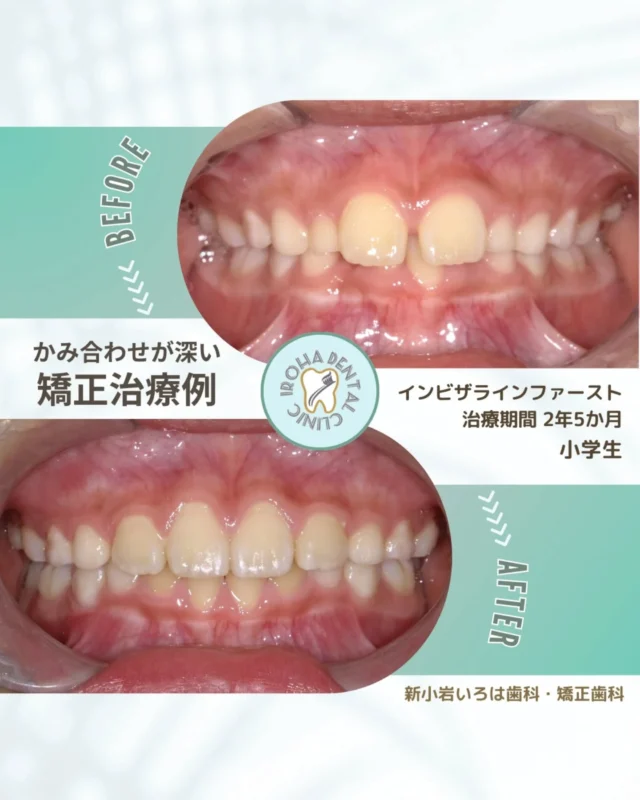 こんにちは！新小岩いろは歯科です🌿

今回は、マウスピース矯正による小学校中学年患者さまの過蓋咬合の治療例をご紹介しました。

学校から持ち帰った歯科検診の結果。
「歯列・咬合」の欄にチェックがついていると、
「いつの間に？」「すぐに矯正しなきゃダメ？」と
不安になってしまいますよね。🦷

実は、学校の検診はあくまで「スクリーニング」。
限られた時間と設備の中で、
「一度詳しく診てもらった方がいいかも！」という子を
見つけるための「ふるい分け」なんです。

🚩 検診の判定「1」や「2」ってどういう意味？
学校の判定は、今すぐ装置をつけるかどうかではなく
「将来のお口の健康リスク」を見ています。

判定1： 成長で変わる可能性もあるけれど、見守りが必要。

判定2： 専門医による詳しい診断が必要なサイン。

「様子見でいいですよ」と言われることも多いですが、
実は「様子を見るべきベストなタイミング」も
一人ひとり違います。

⚠️ こんなサイン、ありませんか？
もしお子様にこんな様子があれば、早めのアドバイスが役立つかもしれません。

・いつもお口がぽかんと開いている

・いびきをかいている、鼻炎がある

・姿勢が気になる

歯並びは見た目だけでなく、
しっかり噛む、正しく話すといった「体全体の成長」に深く関わっています。

「まだ早いかな？」とひとりで悩まず、まずは答え合わせをする感覚で、お気軽にご相談ください😊

今の時期だからこそできる「低負担な準備」があるかもしれません。

🟢 不安な方には「矯正無料相談」から

「費用はどれくらいかかるの？」
「いまのこの歯並びでも治せるの？」

そんな疑問や不安に寄り添うために、当院では矯正無料相談を行っています。

当院では、患者さん一人ひとりの歯並びやライフスタイルに合わせた治療計画をご提案し、疑問や不安に丁寧に耳を傾け、一つひとつ解消していきます。歯並びは本当に人それぞれなので、ぜひ一度お気軽にご相談ください💫

矯正治療を受けるにあたり、ご不安に思っていることや疑問点などございましたら、お気軽にご相談ください🍀

無料相談はプロフィールリンクから💡🌸

@shinkoiwairoha.dc
┈ ┈ ┈┈ ┈ ┈ ┈ ┈┈ ┈ ┈┈ ┈ ┈ ┈ ┈
新小岩いろは歯科・矯正歯科🦷✨
📞03-6231-5751

【公式HP】
https://shinkoiwa-iroha-dc.jp/

@shinkoiwairoha.dc

📍JR新小岩駅徒歩2分　第28東ビル3F
⌚診療時間 ｜ 月〜土 9:00〜17:00
休診日：日曜・祝日
┈ ┈ ┈ ┈ ┈ ┈ ┈ ┈┈ ┈ ┈ ┈ ┈
#歯科検診 #歯並び #子供の矯正 #歯科医院 #咬合