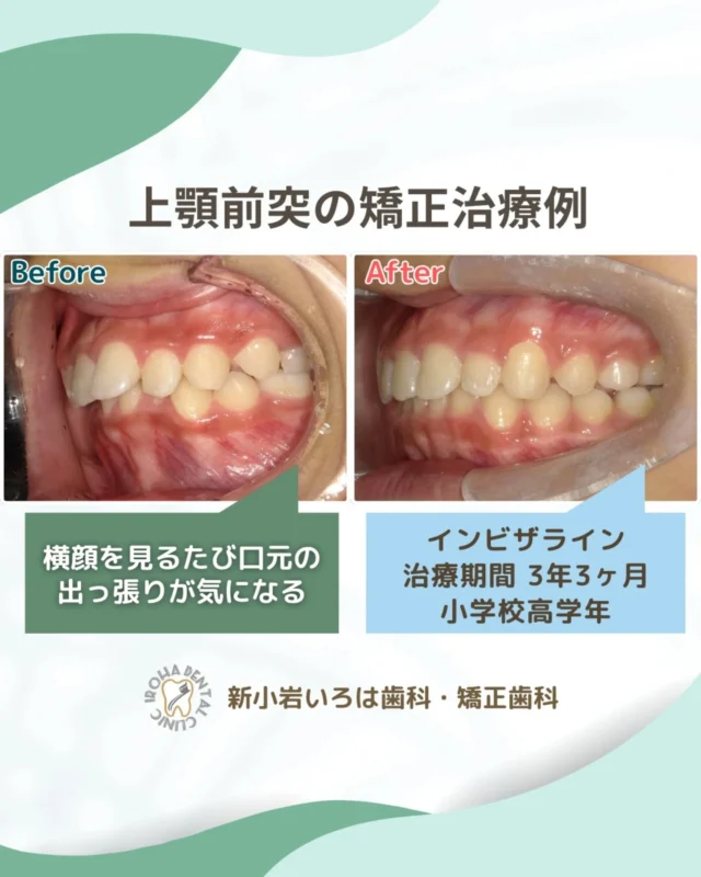 こんにちは！新小岩いろは歯科です🌿

今回は、マウスピース矯正による小学校高学年患者さまの上顎前突の治療例をご紹介しました。

お子さまのふとした横顔や笑った顔を見て、「あれ？ちょっと前歯が出ているかも…」「口がいつも開いているな」と気になったことはありませんか？

それは、お子さまのお口が出している「歯、並ぶスペースが足りないよ！」という大切なサインかもしれません。

🦷 「出っ歯」や「受け口」の放置が怖い理由

「まだ乳歯もあるし、永久歯に変わったら治るかも」と様子を見たくなるお気持ち、よくわかります。ですが、子どもの出っ歯（上顎前突）などは放置すると、骨格のズレがそのまま固まってしまうリスクがあります。

将来、健康な歯を抜いて矯正することになるかも…

口呼吸が癖になり、風邪やアレルギーを引きやすくなる…

見た目のコンプレックスで、思いきり笑えなくなる…

大人になってからの矯正は、費用も期間も、そして痛みなどの負担も大きくなりがちです。

✨ 5〜8歳は、一生に一度の「ゴールデンタイム」

実は、顎の骨が柔らかいこの時期は、「骨格そのものを正しい形に導ける」唯一のチャンス。この時期に適切なアプローチができれば、将来の抜歯リスクをグッと減らし、お子さま本来の健やかな成長をサポートできるのです。

💡 マウスピース矯正（インビザライン）という選択肢

「ワイヤー矯正は痛そうだし、見た目も可哀想…」と迷われているなら、透明なマウスピースを使った矯正がおすすめです。

✅目立たないから、学校で友達に気づかれにくい。

✅取り外せるから、大好きなごはんも美味しく食べられる。

✅痛みが少ないから、お子さまのストレスを最小限に。

何より、自分で装置を管理することで「自分の体を大切にする習慣」や「目標に向かって頑張る力」も育まれます。

🟢「まずは相談だけ」で大丈夫です
大切なお子さまの未来のために、今できることは「正しく知る」こと。

「今始めるべき？」「うちの子でも続けられる？」
そんな親御さんの不安に、新小岩いろは歯科では、プロとして、そしてお子さまの成長を願うパートナーとして丁寧にお答えします。

気づいたときが、最高のタイミング。
お子さまが将来、自分の笑顔に自信を持って羽ばたいていけるように。新小岩いろは歯科で、まずは一歩、未来のための相談を始めてみませんか？

🟢 不安な方には「矯正無料相談」から

「費用はどれくらいかかるの？」
「いまのこの歯並びでも治せるの？」

そんな疑問や不安に寄り添うために、当院では矯正無料相談を行っています。

当院では、患者さん一人ひとりの歯並びやライフスタイルに合わせた治療計画をご提案し、疑問や不安に丁寧に耳を傾け、一つひとつ解消していきます。歯並びは本当に人それぞれなので、ぜひ一度お気軽にご相談ください💫

矯正治療を受けるにあたり、ご不安に思っていることや疑問点などございましたら、お気軽にご相談ください🍀

無料相談はプロフィールリンクから💡🌸

@shinkoiwairoha.dc
┈ ┈ ┈┈ ┈ ┈ ┈ ┈┈ ┈ ┈┈ ┈ ┈ ┈ ┈
新小岩いろは歯科・矯正歯科🦷✨
📞03-6231-5751

【公式HP】
https://shinkoiwa-iroha-dc.jp/

@shinkoiwairoha.dc

📍JR新小岩駅徒歩2分　第28東ビル3F
⌚診療時間 ｜ 月〜土 9:00〜17:00
休診日：日曜・祝日
┈ ┈ ┈ ┈ ┈ ┈ ┈ ┈┈ ┈ ┈ ┈ ┈
#歯科検診 #歯並び #子供の矯正 #歯科医院 #咬合