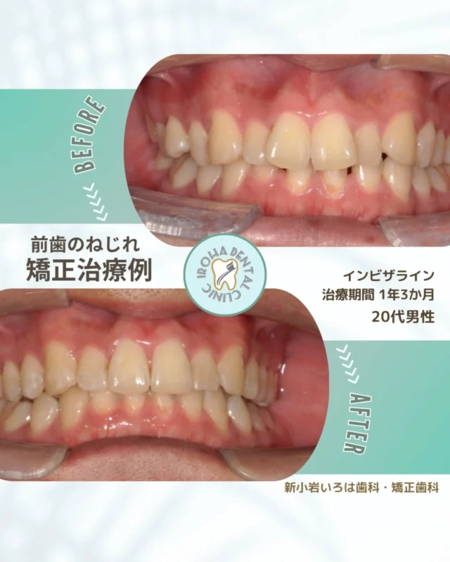 こんにちは！新小岩いろは歯科です🌿

今回は、マウスピース矯正による20代患者さまの治療例をご紹介しました。

前歯のねじれは、わずかなものでも口を開けたときに目に入りやすく、気になってしまう方が少なくありません。

歯がねじれて生えている状態を、専門用語で「捻転（ねんてん）」と呼びます。

🦷 なぜ前歯はねじれてしまうのか？

実は、さまざまな原因が隠れています。

スペース不足： あごが小さく、歯が並ぶ場所が足りない。

乳歯の影響： 子供の頃の虫歯や、抜けるタイミングのズレ。

過剰歯や遺伝： 生まれつきの歯の本数や位置の関係。

⚠️ 「少しのねじれ」を放置する本当のリスク

見た目の悩みはもちろんですが、実は「健康の寿命」にも関わります。

ねじれた部分は歯ブラシが届きにくく、虫歯や歯周病の温床になりやすいのです。

さらに、うまく噛み切れないことで他の歯に負担がかかり、将来的に歯が割れてしまうリスクも……。

✨ インビザラインなら「部分矯正」で賢く治せるかも？

「全体を直すほどじゃないし、ワイヤーは目立つから嫌だ」
そう思って諦めていた方にこそ、インビザラインはおすすめです。

目立たない： 透明なマウスピースだから、仕事もプライベートもそのまま。

短期間・低コスト： 軽度のねじれなら、半年〜1年程度の「部分矯正」で改善できるケースも多いです。

勇気を出して、理想の笑顔への一歩を。

「自分のねじれ方は、インビザラインで治るのかな？」

「いくらくらいかかるんだろう？」

そんな不安を解消するために、まずはプロの診断を受けてみませんか？

当院では、矯正治療の無料カウンセリングを行っています。

🟢 不安な方には「矯正無料相談」から

「費用はどれくらいかかるの？」

「いまのこの歯並びでも治せるの？」

そんな疑問や不安に寄り添うために、当院では矯正無料相談を行っています。

当院では、患者さん一人ひとりの歯並びやライフスタイルに合わせた治療計画をご提案し、疑問や不安に丁寧に耳を傾け、一つひとつ解消していきます。

歯並びは本当に人それぞれなので、ぜひ一度お気軽にご相談ください💫

矯正治療を受けるにあたり、ご不安に思っていることや疑問点などございましたら、お気軽にご相談ください🍀

無料相談はプロフィールリンクから💡🌸

@shinkoiwairoha.dc
┈ ┈ ┈┈ ┈ ┈ ┈ ┈┈ ┈ ┈┈ ┈ ┈ ┈ ┈
新小岩いろは歯科・矯正歯科🦷✨
📞03-6231-5751

【公式HP】
https://shinkoiwa-iroha-dc.jp/

@shinkoiwairoha.dc

📍JR新小岩駅徒歩2分　第28東ビル3F
⌚診療時間 ｜ 月〜土 9:00〜17:00
休診日：日曜・祝日
┈ ┈ ┈ ┈ ┈ ┈ ┈ ┈┈ ┈ ┈ ┈ ┈
#インビザライン #マウスピース矯正 #部分矯正 #前歯のねじれ #捻転歯
