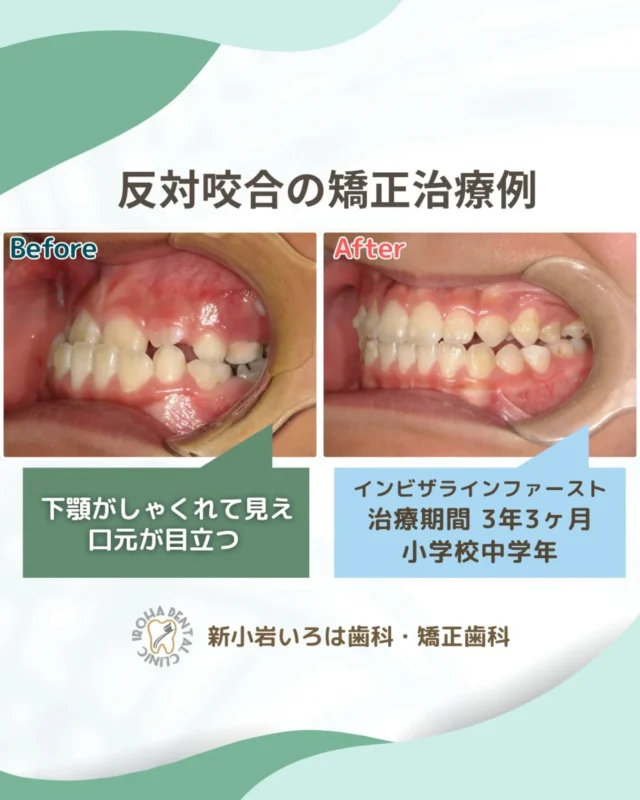 こんにちは！新小岩いろは歯科です🌿

今回は、マウスピース矯正による小学校中学年患者さまの反対咬合の治療例をご紹介しました。

「うちの子、もしかして受け口…？」
「成長したら自然に治るのかな？」

そんな不安を抱えながら、
日々お子さんの様子を見守っている保護者の方も
多いのではないでしょうか。

「反対咬合（受け口）」は、
見た目だけの問題ではありません。
実は、健やかな成長に関わる
大切なサインかもしれないのです。

「まだ小さいから様子を見よう」
そう思っている間に、
骨格的な問題が進行してしまうこともあります。
子どもの顎は、今まさに成長の真っ最中。
その力を利用できる「今」だからこそ、負担を少なく、効果的な治療ができる可能性があるのです。

反対咬合をそのままにしておくと…
🔵 食べ物が噛みにくく、消化不良の原因に
🔵 「サ行」や「タ行」の発音がしづらくなる
🔵 顎の関節に負担がかかり、将来のトラブルに

「あの時、相談してよかった」
そう思える一歩を。
まずは、矯正のプロに相談してみませんか？

新小岩いろは歯科矯正歯科では、お子様一人ひとりの成長段階に合わせ、最適な治療のタイミングをご提案します。

ムーシールドやマイオブレースなど、お子様への負担に配慮した治療法もございます。

「相談＝治療開始」ではありません。
今の状態を知り、将来の見通しを立てる。
それだけでも、心のモヤモヤが晴れるはずです。

お子様の、一生モノの笑顔と健康のために。
最初の一歩を、一緒に踏み出しませんか？
お気軽にご相談ください🍀

🟢 不安な方には「矯正無料相談」から

「費用はどれくらいかかるの？」
「いまのこの歯並びでも治せるの？」

そんな疑問や不安に寄り添うために、当院では矯正無料相談を行っています。

当院では、患者さん一人ひとりの歯並びやライフスタイルに合わせた治療計画をご提案し、疑問や不安に丁寧に耳を傾け、一つひとつ解消していきます。歯並びは本当に人それぞれなので、ぜひ一度お気軽にご相談ください💫

矯正治療を受けるにあたり、ご不安に思っていることや疑問点などございましたら、お気軽にご相談ください🍀

無料相談はプロフィールリンクから💡🌸

@shinkoiwairoha.dc
┈ ┈ ┈┈ ┈ ┈ ┈ ┈┈ ┈ ┈┈ ┈ ┈ ┈ ┈
新小岩いろは歯科・矯正歯科🦷✨
📞03-6231-5751

【公式HP】
https://shinkoiwa-iroha-dc.jp/

@shinkoiwairoha.dc

📍JR新小岩駅徒歩2分　第28東ビル3F
⌚診療時間 ｜ 月〜土 9:00〜17:00
休診日：日曜・祝日
┈ ┈ ┈ ┈ ┈ ┈ ┈ ┈┈ ┈ ┈ ┈ ┈
#矯正歯科 #小児矯正 #反対咬合 #受け口 #しゃくれ