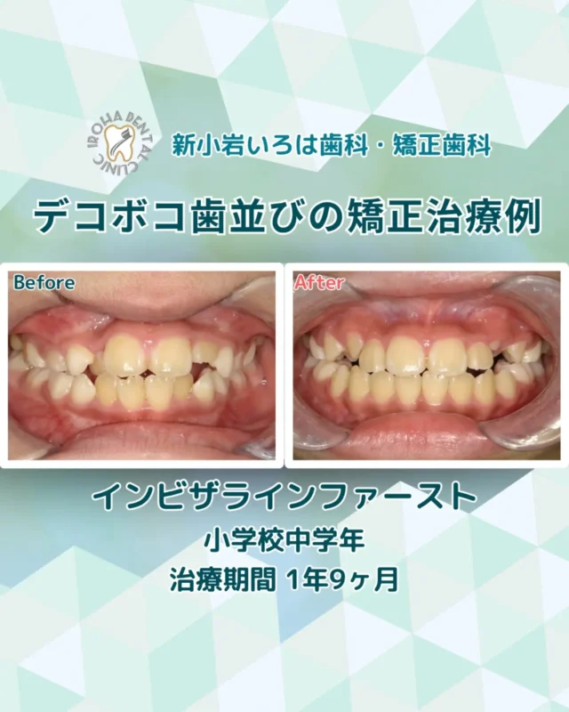 こんにちは！新小岩いろは歯科です🌿

👉今回は、マウスピース矯正による小学校中学年患者さまのデコボコ歯並びの治療例をご紹介しました。

「うちの子、最後まで続けられるかな…」その不安、実は解決できるかもしれません。

「子供の歯並びを綺麗にしてあげたい！」
そう願う一方で、親御さんの頭をよぎる本音。

「痛くて泣き言を言わないかな？」

「ワイヤーを嫌がって外したいって言われたら？」

「高い費用をかけて、途中でやめることになったらどうしよう…」

そんなママ・パパの不安を解消する選択肢が、子どものマウスピース矯正『インビザライン・ファースト』です。

✨ 子どもが「嫌にならない」3つの理由

1. 「痛い」のイメージが変わる
ワイヤーのように一気に締め付けるのではなく、1週間ごとに新しいマウスピースへ交換し、数ミリ単位で優しく動かします。

「調整のたびに痛くて食事ができない」というストレスがほとんどありません。

2. 「見た目」が変わらないから、自信が持てる

透明で目立たないので、学校でお友達にからかわれる心配もありません。多感な時期のお子さまでも、いつもの笑顔のまま治療を続けられます。

3. 「いつもの食事」が一番の楽しみ！

取り外しができるから、大好きなメニューもガムも、今まで通り楽しめます。歯磨きもしやすく、虫歯のリスクを抑えられるのも親御さんには嬉しいポイントですよね。

🌈 「ゴール」が見えるから、やる気が出る

当院では最新の3Dスキャナー『iTero』を導入しています。
その場で「将来どんな歯並びになるか」をシミュレーション。

「僕の歯、こんなに綺麗になるんだ！」

「私、もっと可愛くなれる！」

ゴールを自分の目で見ることで、お子さま自身の「やりたい！」という自立心に火がつきます。実は、自分で管理することが自信に繋がるお子さまも多いんですよ。

🎁 まずは「未来の笑顔」を見に来ませんか？

一生もののプレゼントである「綺麗な歯並び」。
無理強いするのではなく、親子でワクワクしながら進めていける方法を一緒に探しましょう。

【インビザライン・ファースト無料カウンセリング実施中】

無理な勧誘は一切いたしません。

「うちの子でもできるかな？」という相談だけでも大歓迎です。

＼ まずは気軽にお話を聞かせてください ／

当院では、お子様の成長に合わせた最適なタイミングをご提案します。

「これって矯正必要？」
「いくらくらいかかるの？」
そんな些細な疑問も大歓迎です✨

🟢 不安な方には「矯正無料相談」から

「費用はどれくらいかかるの？」

「いまの歯並びでも治せるの？」

そんな疑問や不安に寄り添うために、当院では矯正無料相談を行っています。

当院では、患者さん一人ひとりの歯並びやライフスタイルに合わせた治療計画をご提案し、疑問や不安に丁寧に耳を傾け、一つひとつ解消していきます。歯並びは本当に人それぞれなので、ぜひ一度お気軽にご相談ください💫

矯正治療を受けるにあたり、ご不安に思っていることや疑問点などございましたら、お気軽にご相談ください🍀

無料相談はプロフィールリンクから💡🌸

@shinkoiwairoha.dc
┈ ┈ ┈┈ ┈ ┈ ┈ ┈┈ ┈ ┈┈ ┈ ┈ ┈ ┈
新小岩いろは歯科・矯正歯科🦷✨
📞03-6231-5751

【公式HP】
https://shinkoiwa-iroha-dc.jp/

@shinkoiwairoha.dc

📍JR新小岩駅徒歩2分　第28東ビル3F
⌚診療時間 ｜ 月〜土 9:00〜17:00
休診日：日曜・祝日
┈ ┈ ┈ ┈ ┈ ┈ ┈ ┈┈ ┈ ┈ ┈ ┈
#小児矯正 #インビザラインファースト #子供の歯並び #新小岩歯医者 #マウスピース矯正