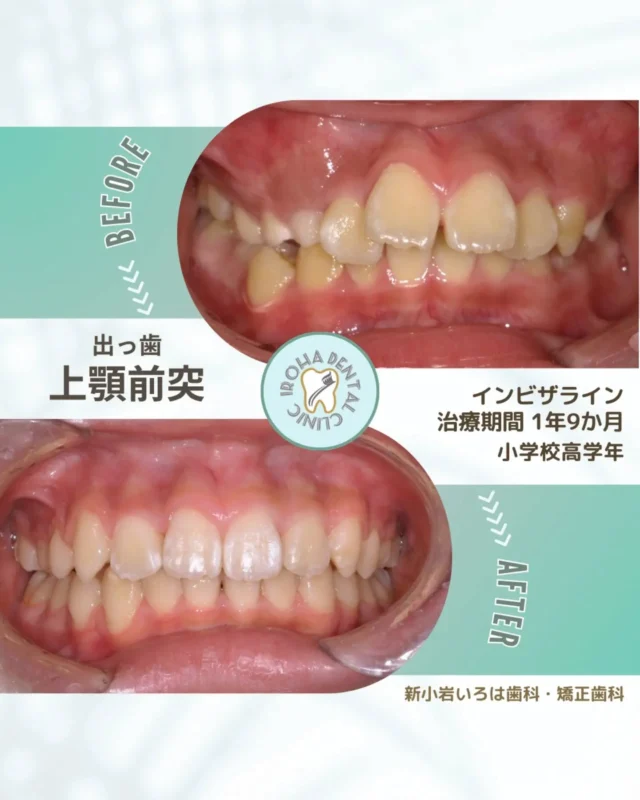こんにちは！新小岩いろは歯科です🌿

【一生の自信を育む、親から子への贈り物】

「最近、うちの子の上の前歯が少し目立つ気がする……」

「これって、いわゆる『出っ歯』なのかな？」

ふとした瞬間の横顔や、笑った時の口元。親だからこそ気づく小さな違和感。

でも、「まだ乳歯があるし」「そのうち自然に治るかも」と、答えを先延ばしにしていませんか？

実は、子供の歯並び、特に「出っ歯（上顎前突）」の悩みは、見た目だけの問題ではありません。それはお子様の「健康」と「心」の成長に、想像以上に深く関わっているのです。

■ 「出っ歯」が引き起こす、見逃せない3つのリスク

「出っ歯」とは、下の歯に対して上の前歯が大きく前に出ている状態を指します。これを放置してしまうと、お子様の将来に以下のような影響が出る可能性があります。

1. 歯の寿命を縮める「ケガ」のリスク

出っ歯のお子様は、転倒した際に前歯を強く打ちつけるリスクが非常に高いと言われています。前歯が突出しているため、唇で守りきれず、歯が折れたり、根元から抜けてしまう事故が少なくありません。一生使う大切な永久歯を守るために、位置を整えることは「予防」にもなるのです。

2. 噛む力と全身の健康への影響

前歯は食べ物を「噛み切る」役割を担っています。しかし出っ歯の状態だと、前歯がうまく機能せず、奥歯ばかりに負担がかかったり、食べ物を丸飲みする癖がついてしまいます。これが消化不良や、将来的な顎関節症、さらには呼吸器系（口呼吸）への悪影響につながることもあります。

3. 「自信」という心への影響

多感な成長期において、口元のコンプレックスはコミュニケーションに影を落とすことがあります。思い切り笑えない、手で口を隠してしまう……。そんな風に自分に自信を持てなくなる前に、親御さんが道を作ってあげることが大切です。

■ 「なぜ出っ歯になるの？」

原因は遺伝だけではありません
「私の歯並びが似てしまったのかも」と自分を責める必要はありません。出っ歯の原因は、遺伝だけではないからです。
実は、日常の小さな「悪習癖（あくしゅうへき）」が大きく関係しています。

✅指しゃぶりがなかなか抜けない

✅ぼーっとしている時に口がぽかんと開いている（口呼吸）

✅舌を突き出す癖や、唇を噛む癖がある

これらの癖が、少しずつ、でも確実に歯を押し出してしまうのです。大切なのは「なぜそうなったか」を後悔することではなく、「これからどう改善するか」を一緒に考えてあげることです。

💡「痛そう、目立つ」——矯正への不安を解消する『インビザライン』

「矯正をさせてあげたいけれど、ワイヤーで痛い思いをさせるのは可哀想……」
そう迷っている親御さんにこそ知っていただきたいのが、マウスピース矯正（インビザライン）という選択肢です。

従来のワイヤー矯正のような「目立つ」「痛い」「食べにくい」といったストレスを大幅に軽減できる、お子様の生活を第一に考えた治療法です。

✨ インビザライン・ファーストのメリット

【目立たない】 透明なマウスピースなので、学校でお友達に冷やかされる心配がありません。

【いつも通り食べられる】 食事の時は取り外せるので、大好きなおやつも、いつものごはんも美味しく食べられます。

【清潔を保てる】 取り外して歯磨きができるので、矯正中に一番怖い「虫歯」のリスクを抑えられます。

【痛みが少ない】 段階的にゆっくり歯を動かすため、お子様の体への負担が最小限です。

■ 6歳前後が「ゴールデンタイム」です

「中学生になってからでいいかな？」と思われがちですが、実は6歳前後が治療を開始するのに最適なタイミングです。

この時期はまだ顎の骨が柔らかく、成長する力を利用して「顎の形そのもの」を整えることができます。早期にアプローチすることで、将来的に健康な歯を抜かずに済む可能性がぐんと高まるのです。

「まだ早いかも」ではなく「今だからできること」がある。
その判断をするためにも、一度専門家のアドバイスを受けてみませんか？

💡新小岩いろは歯科にご相談ください

お子様の歯並びに正解はありません。一人ひとりの成長のペース、癖、そしてご家庭のライフスタイルに合わせて、最適なゴールを一緒に見つけていきましょう。

当院では、親御様の不安に寄り添い、お子様が楽しく通える環境を整えてお待ちしています。

「相談してよかった」
その一言が、お子様の未来の笑顔への第一歩になります。

🟢 不安な方には「矯正無料相談」から

「費用はどれくらいかかるの？」
「いまのこの歯並びでも治せるの？」

そんな疑問や不安に寄り添うために、当院では矯正無料相談を行っています。

当院では、患者さん一人ひとりの歯並びやライフスタイルに合わせた治療計画をご提案し、疑問や不安に丁寧に耳を傾け、一つひとつ解消していきます。歯並びは本当に人それぞれなので、ぜひ一度お気軽にご相談ください💫

矯正治療を受けるにあたり、ご不安に思っていることや疑問点などございましたら、お気軽にご相談ください🍀

無料相談はプロフィールリンクから💡🌸

@shinkoiwairoha.dc
┈ ┈ ┈┈ ┈ ┈ ┈ ┈┈ ┈