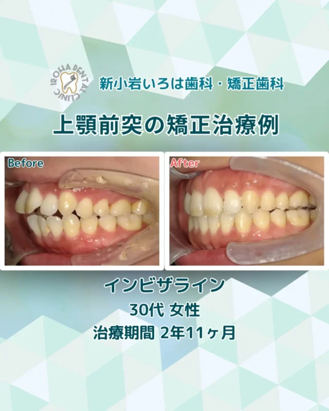 こんにちは！新小岩いろは歯科・矯正歯科です🌿

👉今回は、マウスピース矯正による30代女性の患者さま、上顎前突の治療例をご紹介しました。

「歯並び、ずっと気になってる。でも、今の仕事量で通院なんて無理だよね…」

そう思って、何年も先延ばしにしていませんか？

実は今、「仕事が忙しい社会人こそ、矯正を始める絶好のタイミング」なんです！

毎日忙しく働くあなたが、一歩踏み出せない理由はきっとこれですよね。

「会議中にマウスピースが見えたら恥ずかしい」

「急な残業や出張が入ったら、予約をキャンセルしなきゃいけない」

「そもそも、通い続ける余裕なんてない」

その不安、痛いほどよくわかります。
でも、最新の「マウスピース矯正（インビザライン）」は、そんな現代の働き方に驚くほどフィットするんです✨

💡 社会人の私たちが「今」始めるべき3つの理由

① 「見えない」から、仕事の邪魔をしない

透明で薄いマウスピースは、対面の商談やプレゼン、オンライン会議でもほとんど気づかれません。接客業や営業職の方も、誰にも知られずにこっそり理想の歯並びを目指せます。

② 通院は「1〜2ヶ月に1回」でOK
従来のワイヤー矯正と違い、頻繁に調整に通う必要がありません。通院頻度が低いから、出張が多い方やスケジュールが読めない方でも、計画的に進められます。

③ 「体調管理」も仕事のうち！
意外かもしれませんが、肩こりや頭痛、朝の重だるさの原因が「噛み合わせ」にあることも。矯正で歯並びを整えることは、見た目だけでなく、日々の仕事のパフォーマンス向上にも繋がる「自己投資」なんです。

「全部治す時間はない」という方へ
「前歯のガタつきだけサッと治したい」という方には、3ヶ月〜1年ほどで完了する「部分矯正」という選択肢もあります。期間も費用も抑えて、スマートに印象をアップさせることが可能です。

最後に…
矯正は、単に歯を並べるだけではありません。

「口元を気にせず笑える自信」は、あなたの誠実さや清潔感として、仕事の現場でも必ずプラスに働きます。

「私の場合、どれくらいの期間で終わる？」

「本当に仕事と両立できる？」

そんな小さな疑問を解消するために、まずは一度お話を聞かせてください。

新小岩いろは歯科では、忙しいあなたのライフスタイルに寄り添った、無理のないプランをご提案します。

「あの時始めてよかった！」と思える未来のために。
まずは公式LINEやDMから、お気軽にご相談予約をお待ちしております。

🟢 不安な方には「矯正無料相談」から

「費用はどれくらいかかるの？」

「いまの歯並びでも治せるの？」

そんな疑問や不安に寄り添うために、当院では矯正無料相談を行っています。

当院では、患者さん一人ひとりの歯並びやライフスタイルに合わせた治療計画をご提案し、疑問や不安に丁寧に耳を傾け、一つひとつ解消していきます。歯並びは本当に人それぞれなので、ぜひ一度お気軽にご相談ください💫

矯正治療を受けるにあたり、ご不安に思っていることや疑問点などございましたら、お気軽にご相談ください🍀

無料相談はプロフィールリンクから💡🌸

@shinkoiwairoha.dc
┈ ┈ ┈┈ ┈ ┈ ┈ ┈┈ ┈ ┈┈ ┈ ┈ ┈ ┈
新小岩いろは歯科・矯正歯科🦷✨
📞03-6231-5751

【公式HP】
https://shinkoiwa-iroha-dc.jp/

@shinkoiwairoha.dc

📍JR新小岩駅徒歩2分　第28東ビル3F
⌚診療時間 ｜ 月〜土 9:00〜17:00
休診日：日曜・祝日
┈ ┈ ┈ ┈ ┈ ┈ ┈ ┈┈ ┈ ┈ ┈ ┈
#新小岩いろは歯科 #インビザライン #マウスピース矯正 #社会人の矯正 #歯列矯正