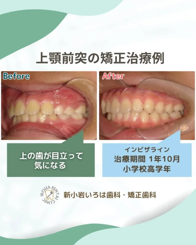こんにちは！新小岩いろは歯科です🌿

今回は、マウスピース矯正による小学校高学年患者さまの上顎前突の治療例をご紹介しました。

「もっと早く相談すればよかった」を、「今相談してよかった」に変えるために。

「まだ乳歯があるし、様子見でいいかな？」
「本人が痛がったら可哀想だし、中学生になってからでいいよね」

そんな風に思っていませんか？実は、子どもの矯正において「相談のベストタイミング」は、親御さんが「あれ？」と気付いたその瞬間です。

なぜなら、子どもの矯正は単に「歯をきれいに並べること」だけが目的ではないからです。

✨ 歯並びは「お口の成長」のサインです

歯がガタガタしていたり、お口がポカンと開いていたりするのは、「顎が正しく成長できていないよ」という体からのサインかもしれません。

4歳から10歳という時期は、顎の成長のピークを迎える「矯正のゴールデンタイム」。この時期に適切なサポート（予防矯正）を行うことで、驚くほどたくさんのメリットが得られます。

✅抜歯やワイヤー矯正を避けられる可能性がアップ

✅顎の成長を利用するから、痛みや負担が少ない

✅治療期間が短くなり、結果として費用も抑えやすい

🌈 歯並びの先にある「一生モノの健康」をプレゼント

予防矯正で変わるのは、見た目だけではありません。

「口呼吸」が改善して鼻呼吸が身につくと、風邪を引きにくくなったり、睡眠の質が上がって日中の集中力がアップしたりすることも。

さらに、しっかり噛めるようになることで、一生続く「食べる力」と「正しい姿勢」の土台が作られます。

あてはまるサインはありませんか？

✅前歯が重なっている、ガタガタしている

✅いつも口がぽかんと開いている

✅「受け口」や「出っ歯」が気になる

✅寝ている時のいびきが気になる

✅学校の検診で指摘された

もし一つでも当てはまるなら、それはお子様の未来を整えるチャンスです。

「相談したらすぐに始めなきゃいけない」なんてことはありません。まずは、お子様の今の成長段階を知ることから始めてみませんか？

新小岩いろは歯科では、ご家族の不安に寄り添い、お子様の個性に合わせた最適なタイミングを一緒に考えます。

数年後、自信に満ちた笑顔で笑うお子様のために。「今」だからできること、一緒に見つけましょう。

🟢 不安な方には「矯正無料相談」から

「費用はどれくらいかかるの？」
「いまのこの歯並びでも治せるの？」

そんな疑問や不安に寄り添うために、当院では矯正無料相談を行っています。

当院では、患者さん一人ひとりの歯並びやライフスタイルに合わせた治療計画をご提案し、疑問や不安に丁寧に耳を傾け、一つひとつ解消していきます。歯並びは本当に人それぞれなので、ぜひ一度お気軽にご相談ください💫

矯正治療を受けるにあたり、ご不安に思っていることや疑問点などございましたら、お気軽にご相談ください🍀

無料相談はプロフィールリンクから💡🌸

@shinkoiwairoha.dc
┈ ┈ ┈┈ ┈ ┈ ┈ ┈┈ ┈ ┈┈ ┈ ┈ ┈ ┈
新小岩いろは歯科・矯正歯科🦷✨
📞03-6231-5751

【公式HP】
https://shinkoiwa-iroha-dc.jp/

@shinkoiwairoha.dc

📍JR新小岩駅徒歩2分　第28東ビル3F
⌚診療時間 ｜ 月〜土 9:00〜17:00
休診日：日曜・祝日
┈ ┈ ┈ ┈ ┈ ┈ ┈ ┈┈ ┈ ┈ ┈ ┈
#小児矯正 #予防矯正 #子供の歯並び #口呼吸改善 #インビザラインファースト