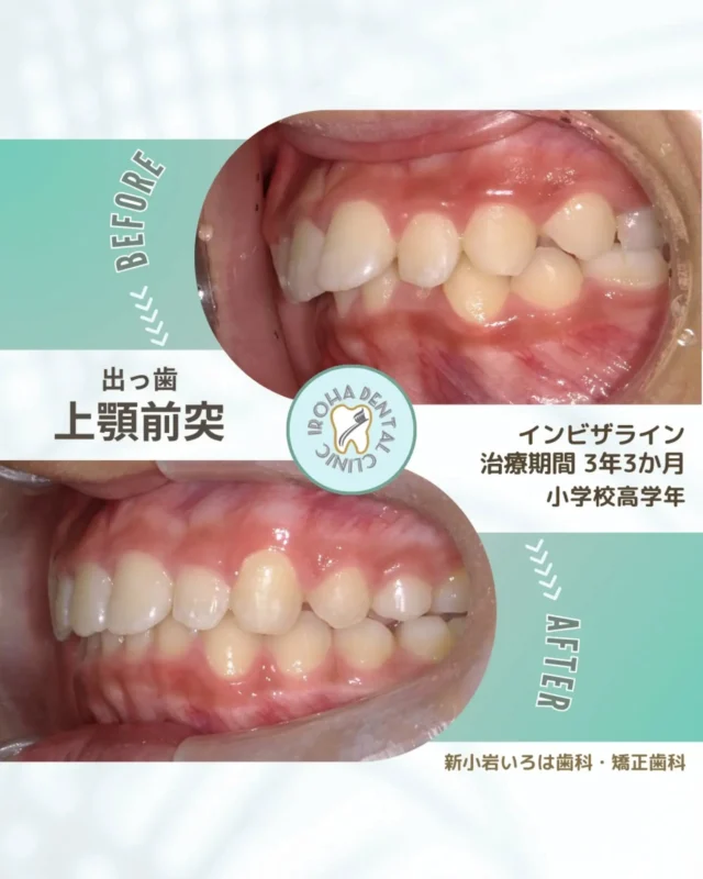 こんにちは！新小岩いろは歯科です🌿

「子どもの矯正、始めてから後悔したくない…」

そう思うのは、親として当然の親心ですよね。

ネットで検索すると、「気になる体験談」や「不安を感じる声」を目にすることもあります。

✅治療期間が長引いた

✅装置のせいで虫歯になってしまった

✅結局、後から抜歯することになった

こうしたトラブルの多くは、実は「事前の診断」や「お子さまに合った装置選び」を丁寧に行うことで、あらかじめ防ぎやすいケースもあります。

🚩 小児矯正を「失敗」にしない3つの約束

大切なお子様の歯を守るために、当院が徹底していることがあります。

① 「なんとなく」で始めない精密な診断

お口の写真やレントゲン（セファロ）はもちろん、顎の成長予測まで含めた「一期矯正」と「二期矯正」の明確なステップをご説明します。

「いつまで、いくらかかるのか」を最初にクリアにすることが、後悔を防ぐ第一歩です。

② 「虫歯リスク」を最小限に抑える
従来のワイヤー矯正で一番の悩みだったのが、磨き残しによる虫歯。
ですが、インビザライン（マウスピース矯正）なら、取り外して隅々まで歯磨きができます！
当院ではプロによるメンテナンスとフッ素洗口も併用し、矯正中の方がお口が綺麗になる環境を目指しています。

③ 「抜歯」の可能性を減らすアプローチ
子供の矯正の最大の武器は「顎の成長」を利用できること。
インビザライン・キッズ等の最新技術で、将来永久歯がきれいに並ぶためのスペースを確保します。早期に取り組むことで、大人になってからの抜歯リスクを最小限に抑えます。

✨ インビザラインなら、お子様の笑顔を奪わない
「痛い、目立つ、食べにくい」という矯正のネガティブなイメージは、もう過去のものです。

痛みが少ないから、習い事や遊びも全力で。

透明で目立たないから、お友達の前でも笑顔のまま。

食事制限なしだから、大好きなものを美味しく。

🩺 まずは「お悩み」を整理しませんか？
「うちの子にはどの方法が合っているの？」

「この歯並びは、今すぐ始めるべき？」

そんな疑問に、経験豊富な歯科医師が一つひとつお答えします。

矯正は単に見た目を整えるだけでなく、一生ものの「噛む力」と「自信」をプレゼントすること。
失敗しないための対策を、私たちと一緒に考えていきましょう。

🟢 不安な方には「矯正無料相談」から

「費用はどれくらいかかるの？」
「いまのこの歯並びでも治せるの？」

そんな疑問や不安に寄り添うために、当院では矯正無料相談を行っています。

当院では、患者さん一人ひとりの歯並びやライフスタイルに合わせた治療計画をご提案し、疑問や不安に丁寧に耳を傾け、一つひとつ解消していきます。歯並びは本当に人それぞれなので、ぜひ一度お気軽にご相談ください💫

矯正治療を受けるにあたり、ご不安に思っていることや疑問点などございましたら、お気軽にご相談ください🍀

無料相談はプロフィールリンクから💡🌸

@shinkoiwairoha.dc
┈ ┈ ┈┈ ┈ ┈ ┈ ┈┈ ┈ ┈┈ ┈ ┈ ┈ ┈
新小岩いろは歯科・矯正歯科🦷✨
📞03-6231-5751

【公式HP】
https://shinkoiwa-iroha-dc.jp/

@shinkoiwairoha.dc

📍JR新小岩駅徒歩2分　第28東ビル3F
⌚診療時間 ｜ 月〜土 9:00〜17:00
休診日：日曜・祝日
┈ ┈ ┈ ┈ ┈ ┈ ┈ ┈┈ ┈ ┈ ┈ ┈
#小児矯正 #子供の歯並び #インビザラインキッズ #マウスピース矯正 #歯列矯正