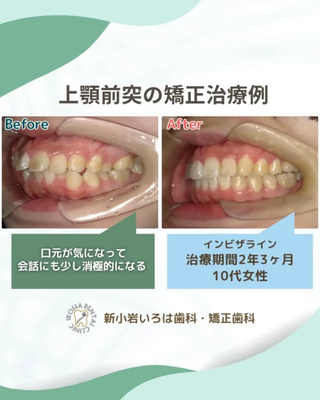 こんにちは！新小岩いろは歯科です🌿

「横顔に自信を持ちたい」その一歩が、あなたの表情を劇的に変える。
「「出っ歯かも」と思うと、会話にも少し消極的になる」
「鏡で見るたび、口元の突出感がどうしても気になる」

そんな悩みを抱えながらも、「矯正は目立つし、痛そう」「抜歯が必要なほど大掛かりなのは怖い」と、治療をためらっていませんか？

出っ歯（上顎前突）は、単なる見た目の問題だけではありません。記事にもある通り、口が閉じにくいことでドライマウスを招き、将来的な虫歯や歯周病のリスクを高める原因にもなります。

もし「今の自分にもう少し自信が持てたら」と感じているなら、マウスピース矯正（インビザライン）という選択肢が、そっと背中を押してくれるかもしれません。

💡なぜ、インビザラインが選ばれるのか？

🔵かつての矯正治療といえば、ワイヤーが目立ちやすく、食事や会話に少し不便さを感じることもありました。ですが、インビザラインはそうしたイメージを変えてくれる選択肢です。

🔵「気づかれない」という自由
透明なマウスピースは、装着していても周囲にほとんど気づかれません。接客業や大切なイベントを控えている方でも、今のライフスタイルを変えることなく治療を始められます。

🔵食事も歯磨きも、いつも通り
取り外しが可能なため、食べたいものを我慢する必要はありません。歯磨きも普段通り行えるので、お口を清潔に保ちやすく、矯正中のトラブルも最小限に抑えられます。

🔵ゴールが見える安心感
独自の3Dシミュレーションにより、「自分の歯がどう動き、最終的にどんな横顔になるのか」を事前に視覚的に確認でき、ゴールの見えない不安が、ワクワクする期待感へと変わる瞬間です。

💡「抜歯が怖い」その不安に寄り添います

上顎前突の治療では、スペースを確保するために抜歯が検討されることもありますが、近年ではインビザラインの技術の進歩により、歯への負担を抑えながら、できるだけ抜歯を行わずに対応できる可能性も広がっています。

新小岩いろは歯科では、患者様お一人おひとりの骨格や筋肉のバランスに加え、「どうなりたいか」というご希望も大切にしながら、しっかりお話を伺い、医学的な根拠に基づいた最適なプランをご提案しています。

💡未来の自分へ、最高のプレゼントを

「もっと早く相談しておけばよかった」治療を終えた多くの方が、共通して口にする言葉です。

横顔のEラインが整い、口元がスッキリすると、表情全体が明るくなり、自分自身に大きな自信が持てるようになります。今の小さな勇気が、数年後のあなたを支える一生モノの財産になります。

まずは、あなたの「なりたい姿」を私たちに聞かせてください。新小岩いろは歯科の矯正相談は、不安を解消しながら、理想の笑顔に近づくために寄り添います。

🟢 不安な方には「矯正無料相談」から

「費用はどれくらいかかるの？」
「いまのこの歯並びでも治せるの？」

そんな疑問や不安に寄り添うために、当院では矯正無料相談を行っています。

当院では、患者さん一人ひとりの歯並びやライフスタイルに合わせた治療計画をご提案し、疑問や不安に丁寧に耳を傾け、一つひとつ解消していきます。歯並びは本当に人それぞれなので、ぜひ一度お気軽にご相談ください💫

矯正治療を受けるにあたり、ご不安に思っていることや疑問点などございましたら、お気軽にご相談ください🍀

無料相談はプロフィールリンクから💡🌸

@shinkoiwairoha.dc
┈ ┈ ┈┈ ┈ ┈ ┈ ┈┈ ┈ ┈┈ ┈ ┈ ┈ ┈
新小岩いろは歯科・矯正歯科🦷✨
📞03-6231-5751

【公式HP】
https://shinkoiwa-iroha-dc.jp/

@shinkoiwairoha.dc

📍JR新小岩駅徒歩2分　第28東ビル3F
⌚診療時間 ｜ 月〜土 9:00〜17:00
休診日：日曜・祝日
┈ ┈ ┈ ┈ ┈ ┈ ┈ ┈┈ ┈ ┈ ┈ ┈
#出っ歯 #出っ歯矯正 #上顎前突 #口元美人 #Eライン
